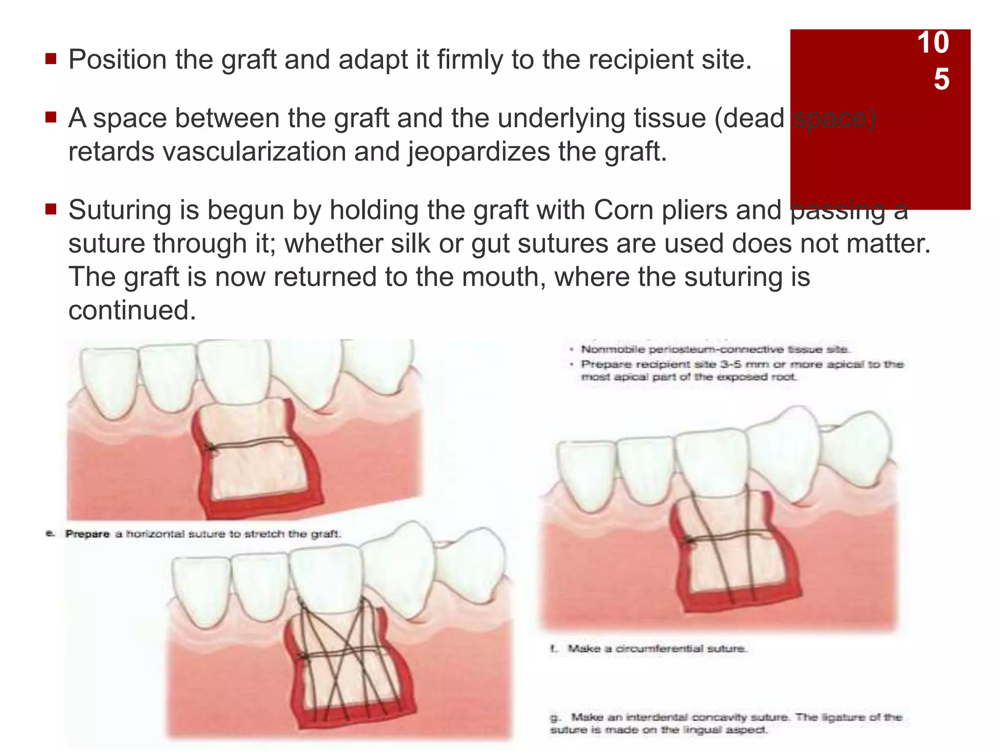  Position the graft and adapt it firmly to the recipient site.
 A space between the graft and the underlying tissue (dead space)
retards vascularization and jeopardizes the graft.
 Suturing is begun by holding the graft with Corn pliers and passing a
suture through it; whether silk or gut sutures are used does not matter.
The graft is now returned to the mouth, where the suturing is
continued.
10
5
 