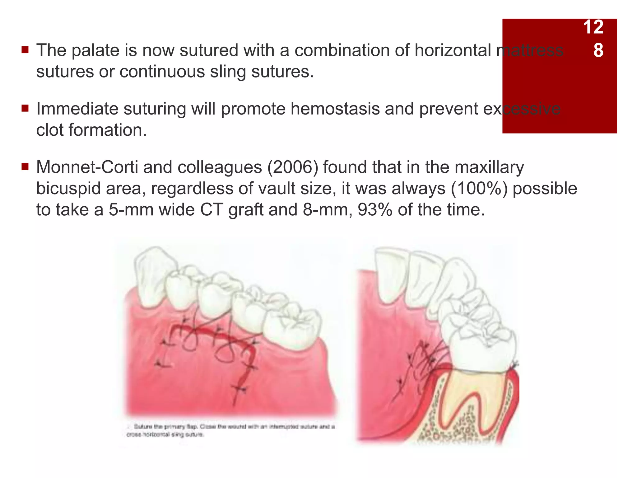  The palate is now sutured with a combination of horizontal mattress
sutures or continuous sling sutures.
 Immediate suturing will promote hemostasis and prevent excessive
clot formation.
 Monnet-Corti and colleagues (2006) found that in the maxillary
bicuspid area, regardless of vault size, it was always (100%) possible
to take a 5-mm wide CT graft and 8-mm, 93% of the time.
12
8
 