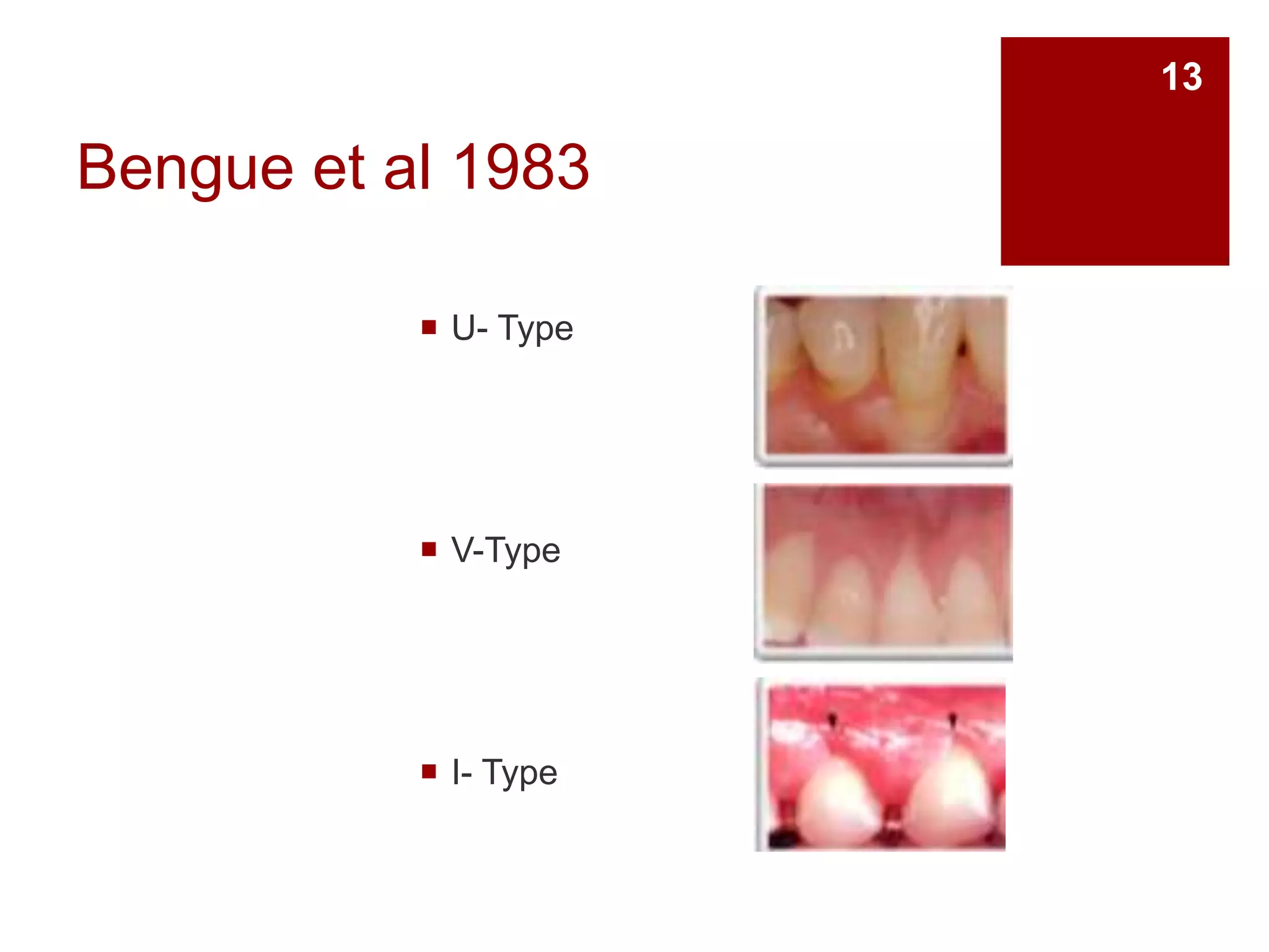 Bengue et al 1983
 U- Type
 V-Type
 I- Type
13
 