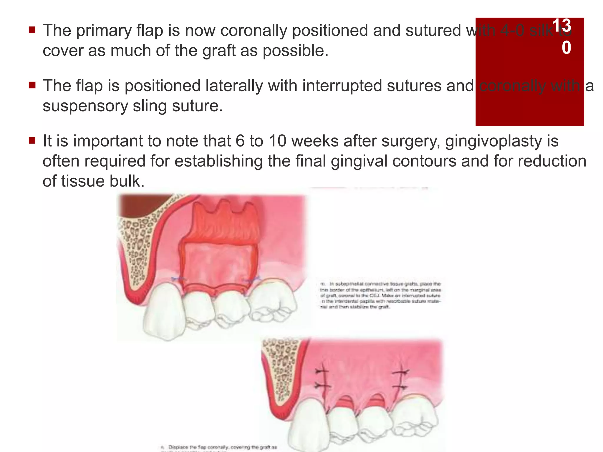  The primary flap is now coronally positioned and sutured with 4-0 silk to
cover as much of the graft as possible.
 The flap is positioned laterally with interrupted sutures and coronally with a
suspensory sling suture.
 It is important to note that 6 to 10 weeks after surgery, gingivoplasty is
often required for establishing the final gingival contours and for reduction
of tissue bulk.
13
0
 