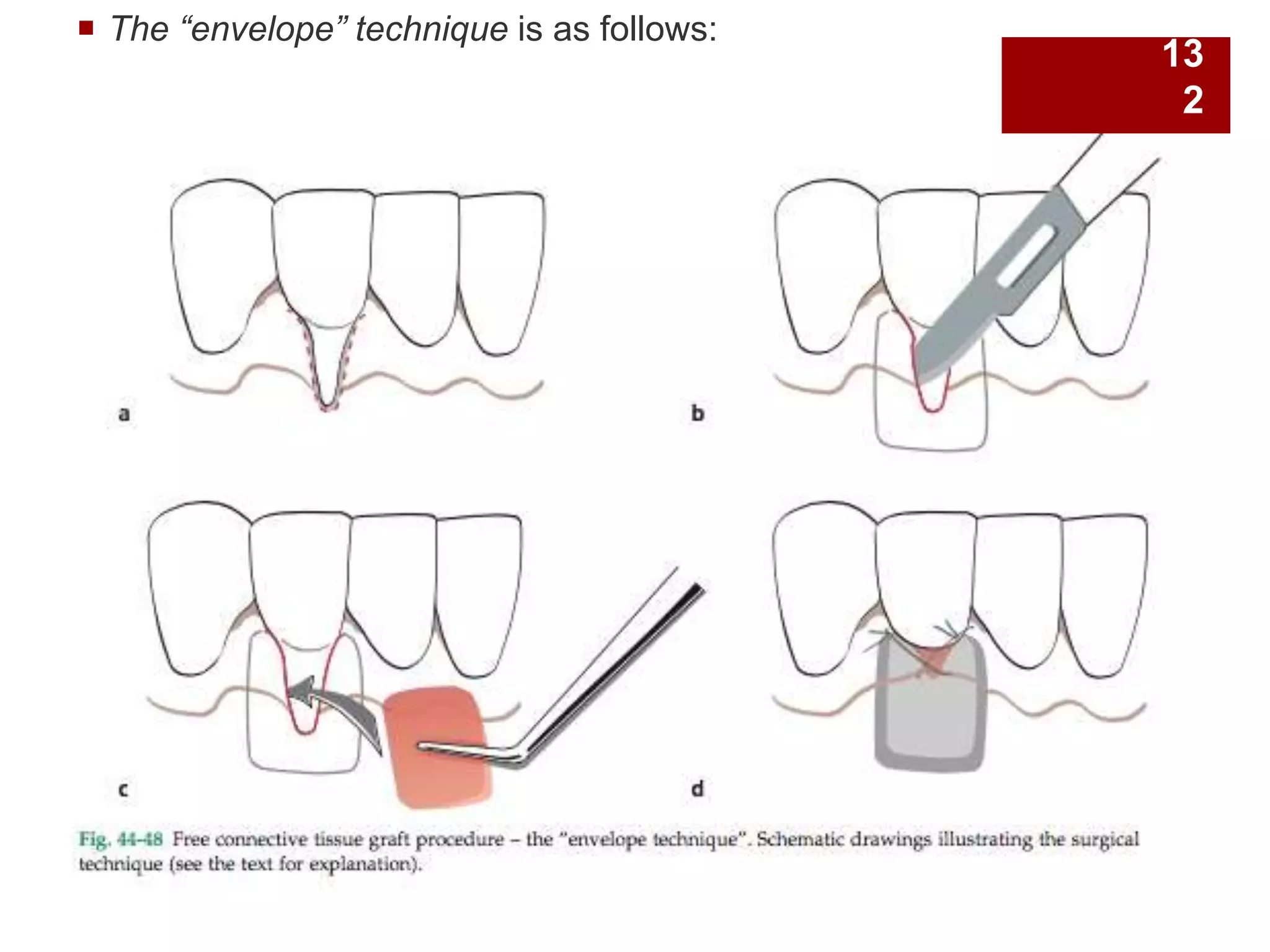  The “envelope” technique is as follows:
13
2
 