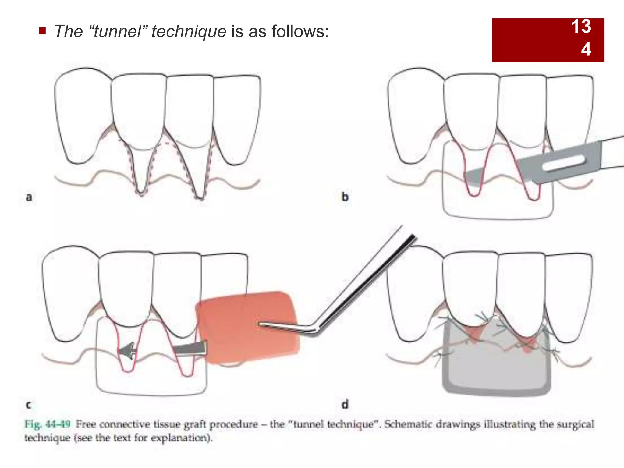  The “tunnel” technique is as follows: 13
4
 