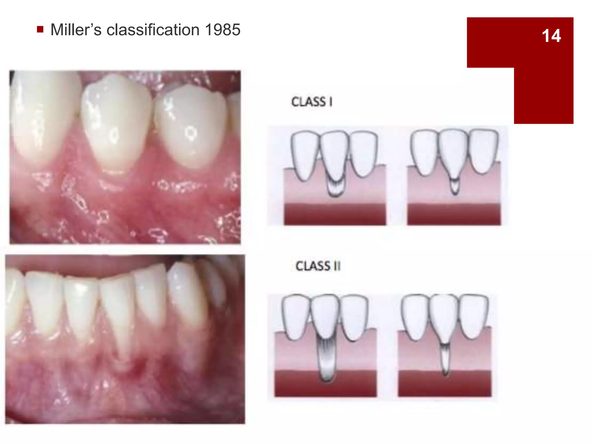  Miller’s classification 1985 14
 
