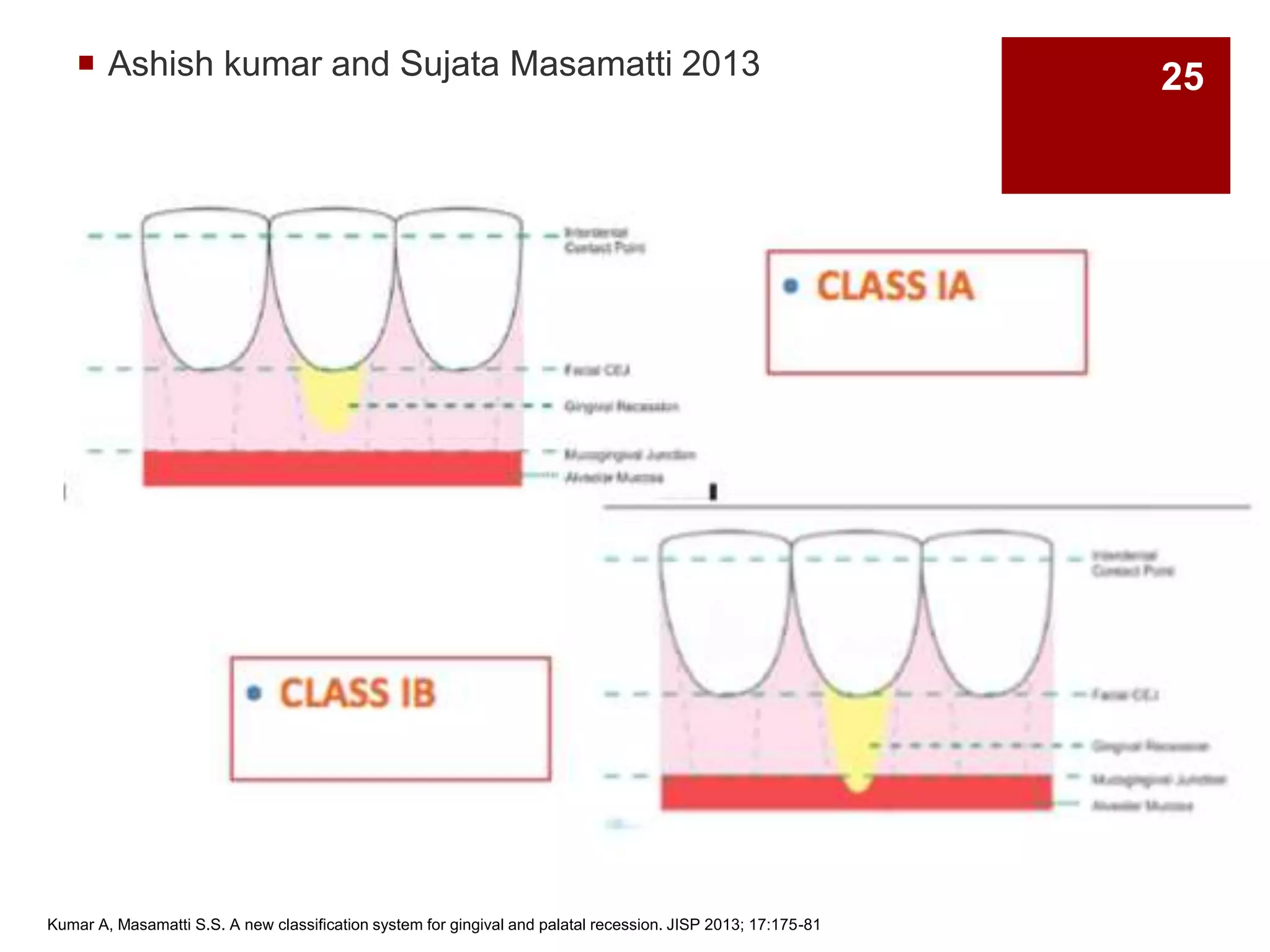 Ashish kumar and Sujata Masamatti 2013
Kumar A, Masamatti S.S. A new classification system for gingival and palatal recession. JISP 2013; 17:175-81
25
 