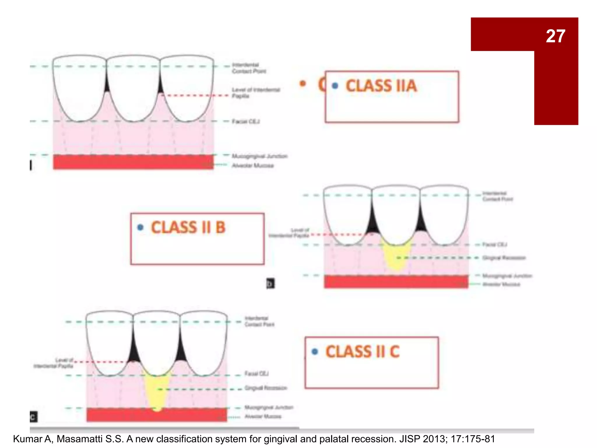 Kumar A, Masamatti S.S. A new classification system for gingival and palatal recession. JISP 2013; 17:175-81
27
 