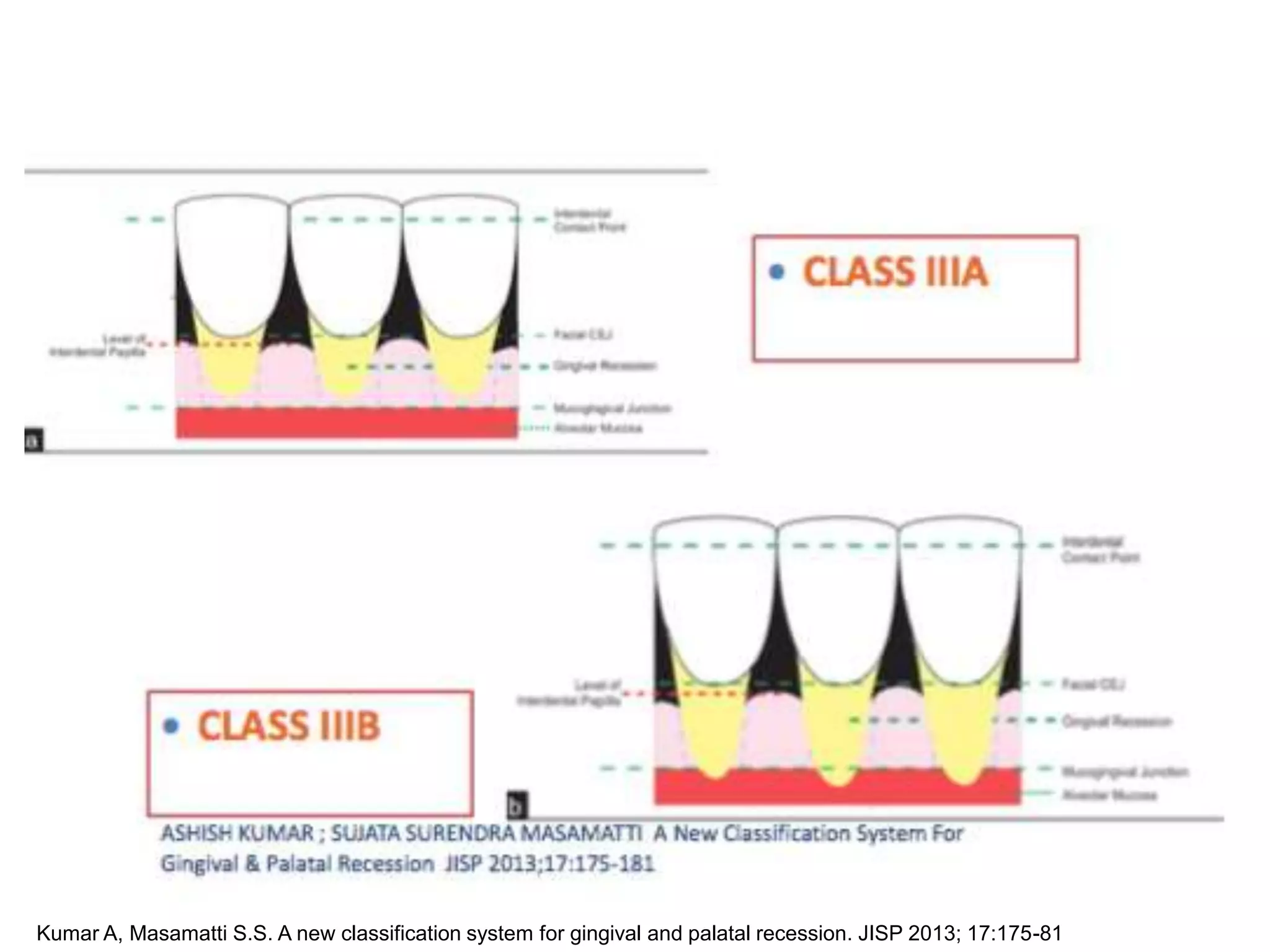 Kumar A, Masamatti S.S. A new classification system for gingival and palatal recession. JISP 2013; 17:175-81
29
 