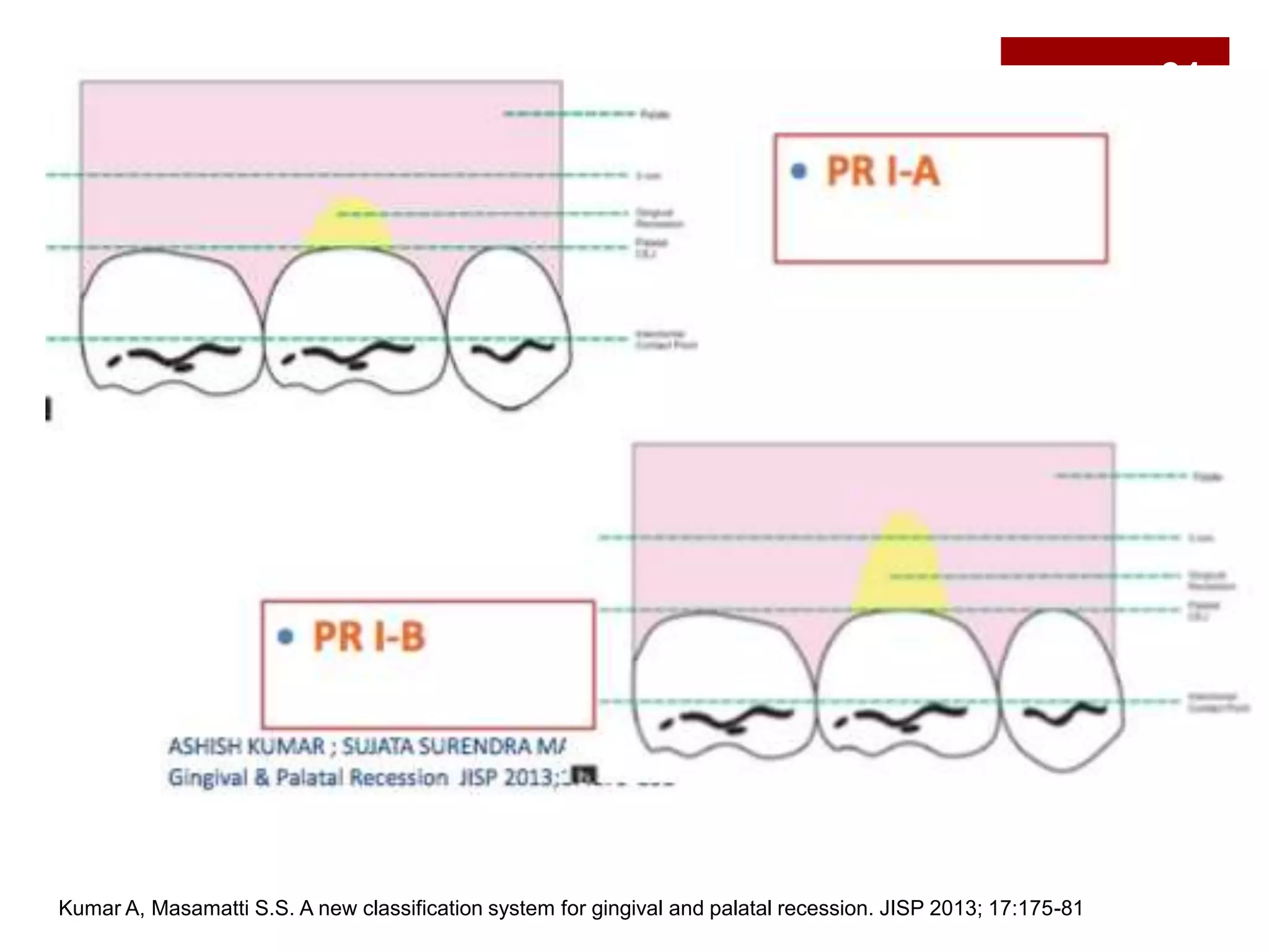 Kumar A, Masamatti S.S. A new classification system for gingival and palatal recession. JISP 2013; 17:175-81
31
 