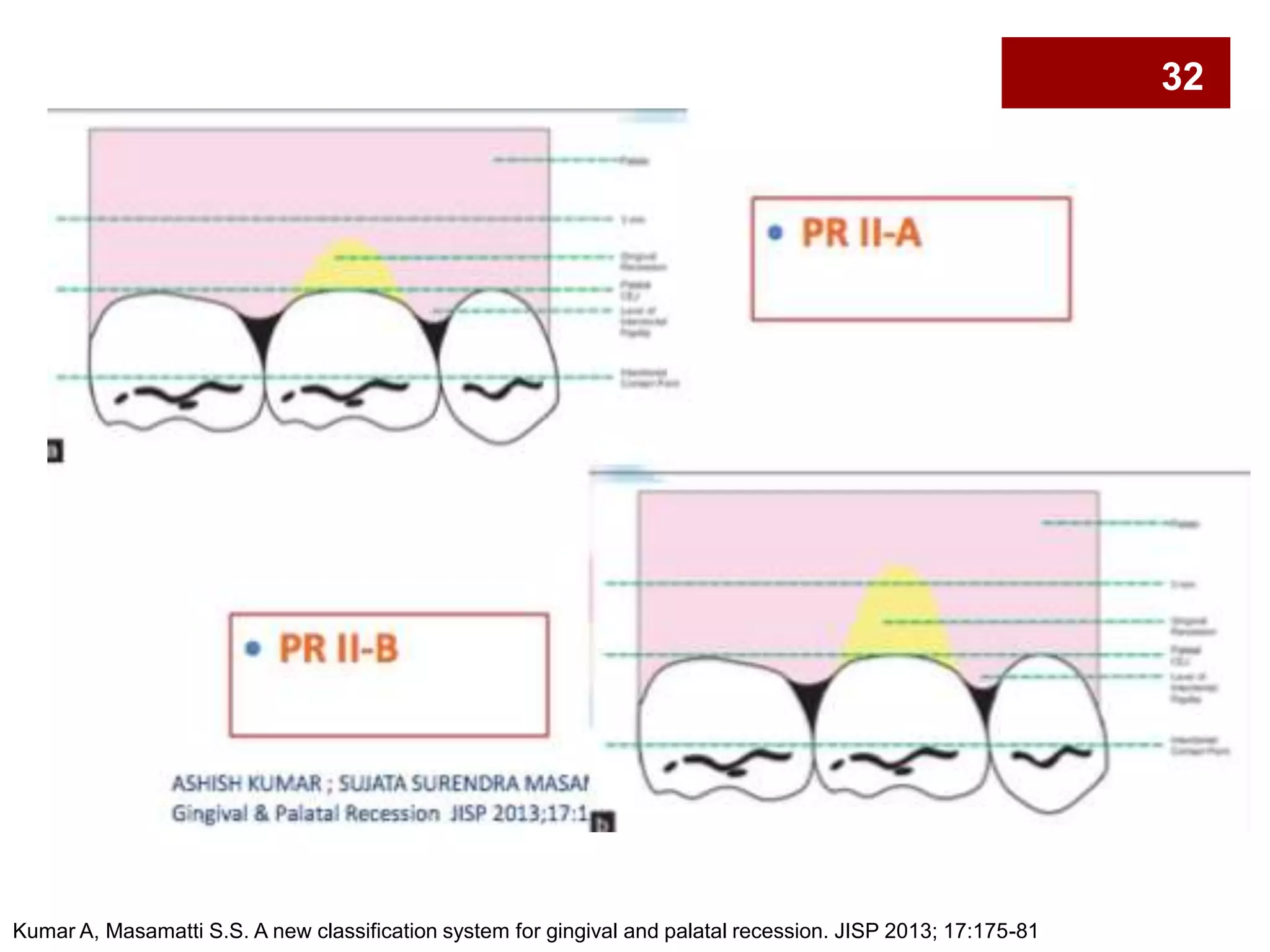 Kumar A, Masamatti S.S. A new classification system for gingival and palatal recession. JISP 2013; 17:175-81
32
 