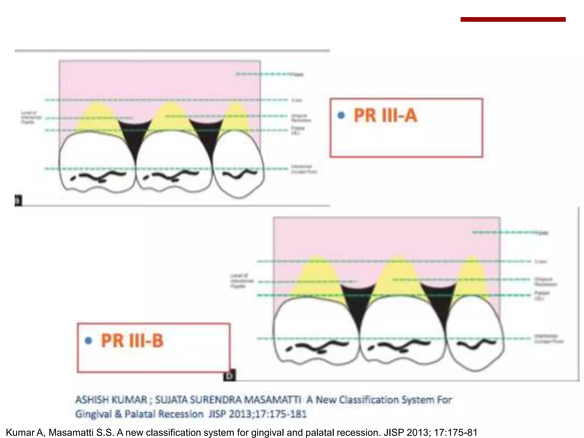 Kumar A, Masamatti S.S. A new classification system for gingival and palatal recession. JISP 2013; 17:175-81
33
 