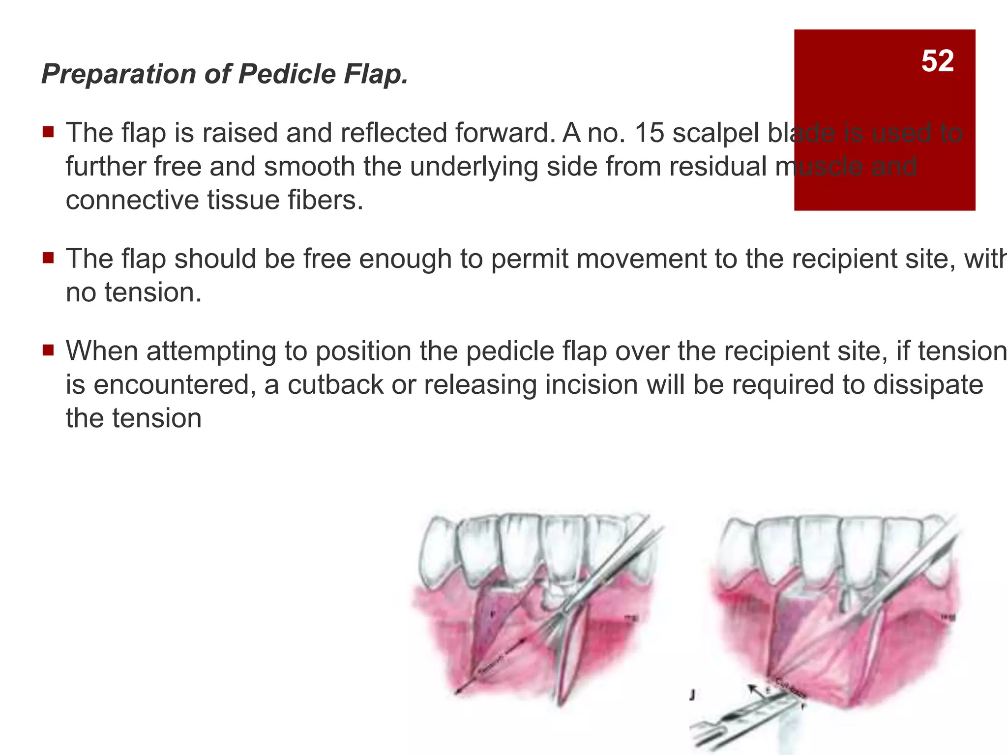 Preparation of Pedicle Flap.
 The flap is raised and reflected forward. A no. 15 scalpel blade is used to
further free and smooth the underlying side from residual muscle and
connective tissue fibers.
 The flap should be free enough to permit movement to the recipient site, with
no tension.
 When attempting to position the pedicle flap over the recipient site, if tension
is encountered, a cutback or releasing incision will be required to dissipate
the tension
52
 