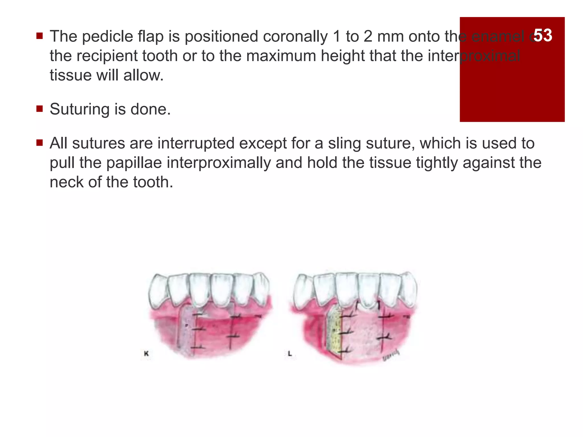  The pedicle flap is positioned coronally 1 to 2 mm onto the enamel of
the recipient tooth or to the maximum height that the interproximal
tissue will allow.
 Suturing is done.
 All sutures are interrupted except for a sling suture, which is used to
pull the papillae interproximally and hold the tissue tightly against the
neck of the tooth.
53
 