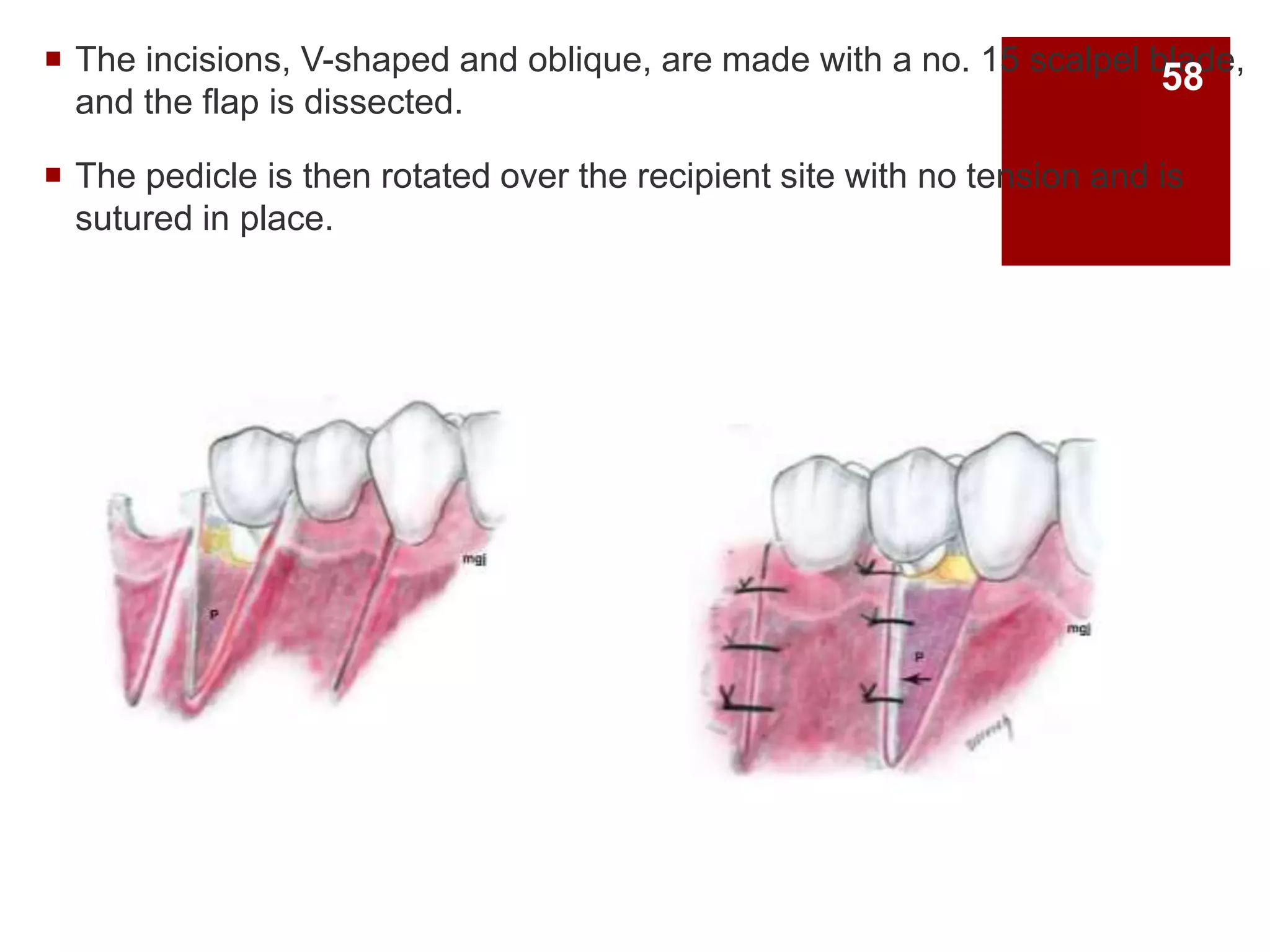  The incisions, V-shaped and oblique, are made with a no. 15 scalpel blade,
and the flap is dissected.
 The pedicle is then rotated over the recipient site with no tension and is
sutured in place.
58
 