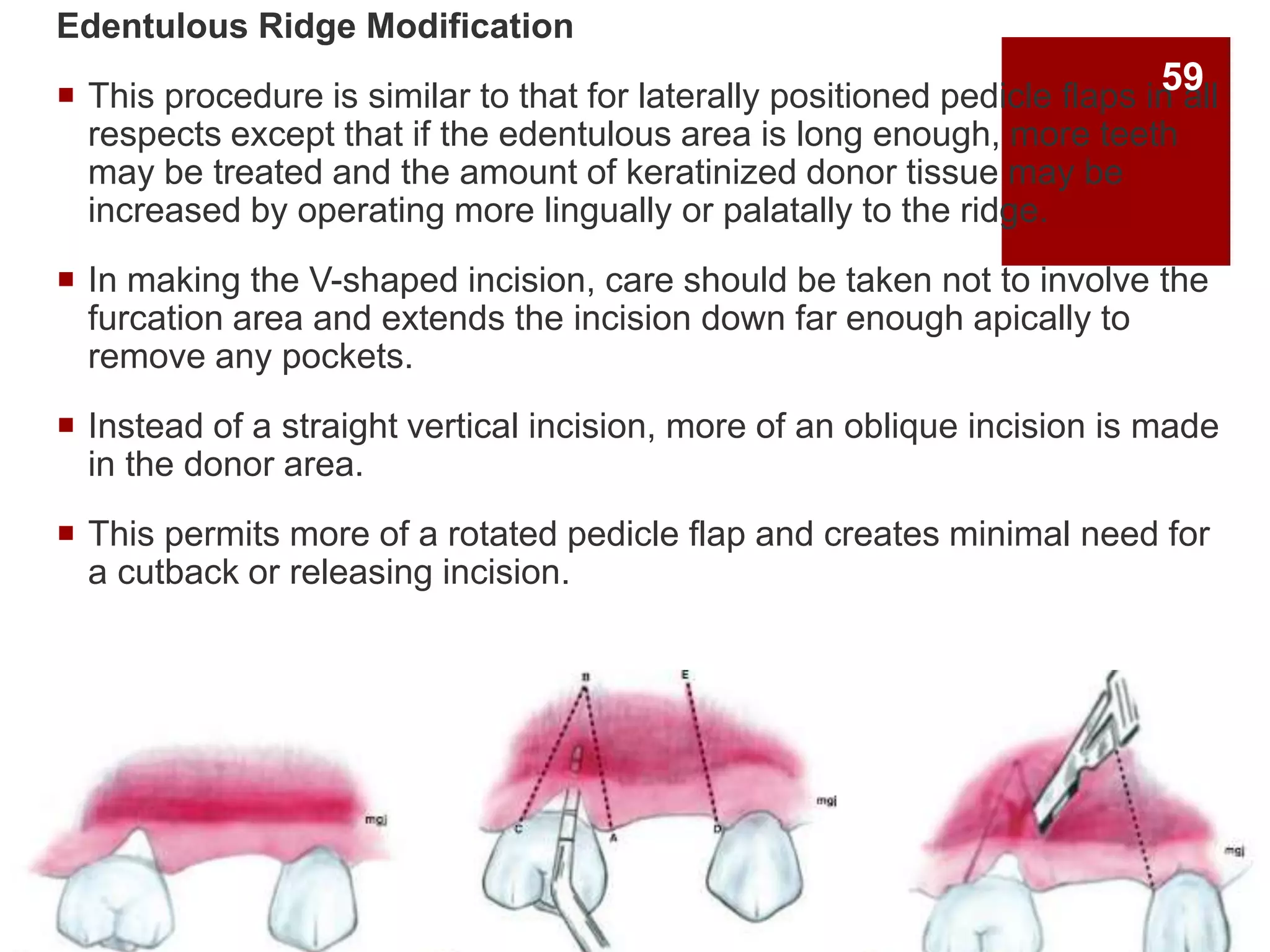 Edentulous Ridge Modification
 This procedure is similar to that for laterally positioned pedicle flaps in all
respects except that if the edentulous area is long enough, more teeth
may be treated and the amount of keratinized donor tissue may be
increased by operating more lingually or palatally to the ridge.
 In making the V-shaped incision, care should be taken not to involve the
furcation area and extends the incision down far enough apically to
remove any pockets.
 Instead of a straight vertical incision, more of an oblique incision is made
in the donor area.
 This permits more of a rotated pedicle flap and creates minimal need for
a cutback or releasing incision.
59
 