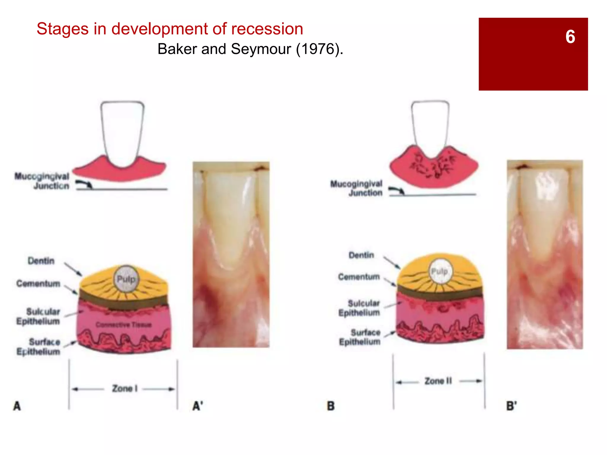 6Stages in development of recession
Baker and Seymour (1976).
 