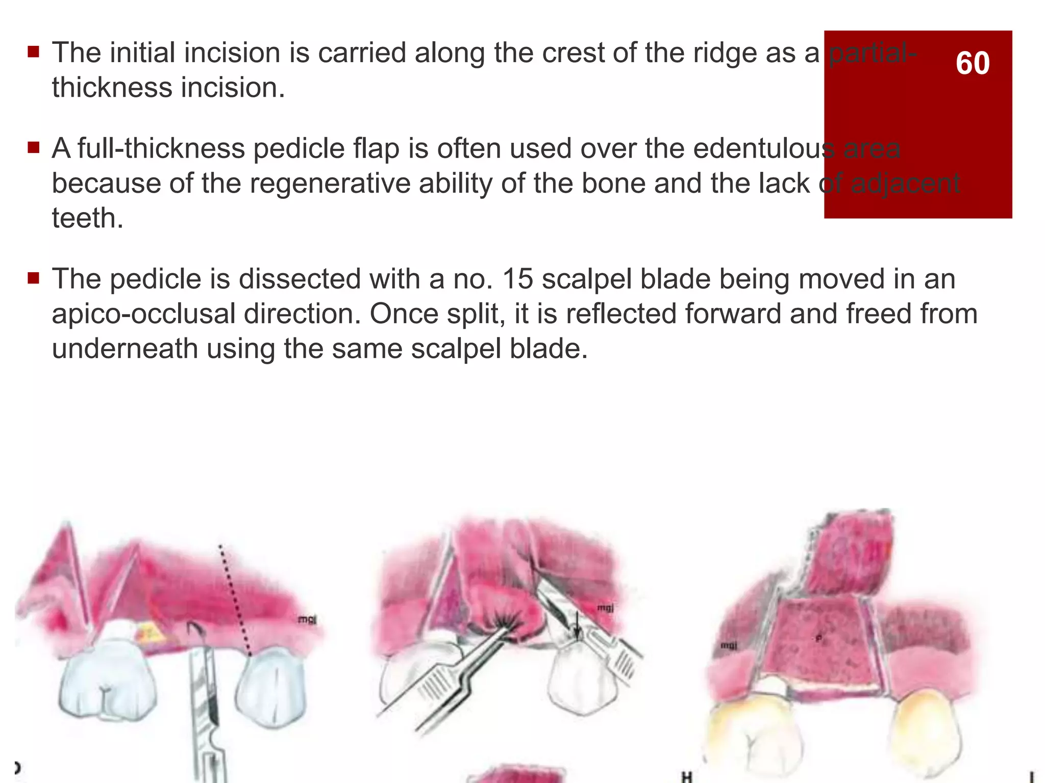  The initial incision is carried along the crest of the ridge as a partial-
thickness incision.
 A full-thickness pedicle flap is often used over the edentulous area
because of the regenerative ability of the bone and the lack of adjacent
teeth.
 The pedicle is dissected with a no. 15 scalpel blade being moved in an
apico-occlusal direction. Once split, it is reflected forward and freed from
underneath using the same scalpel blade.
60
 