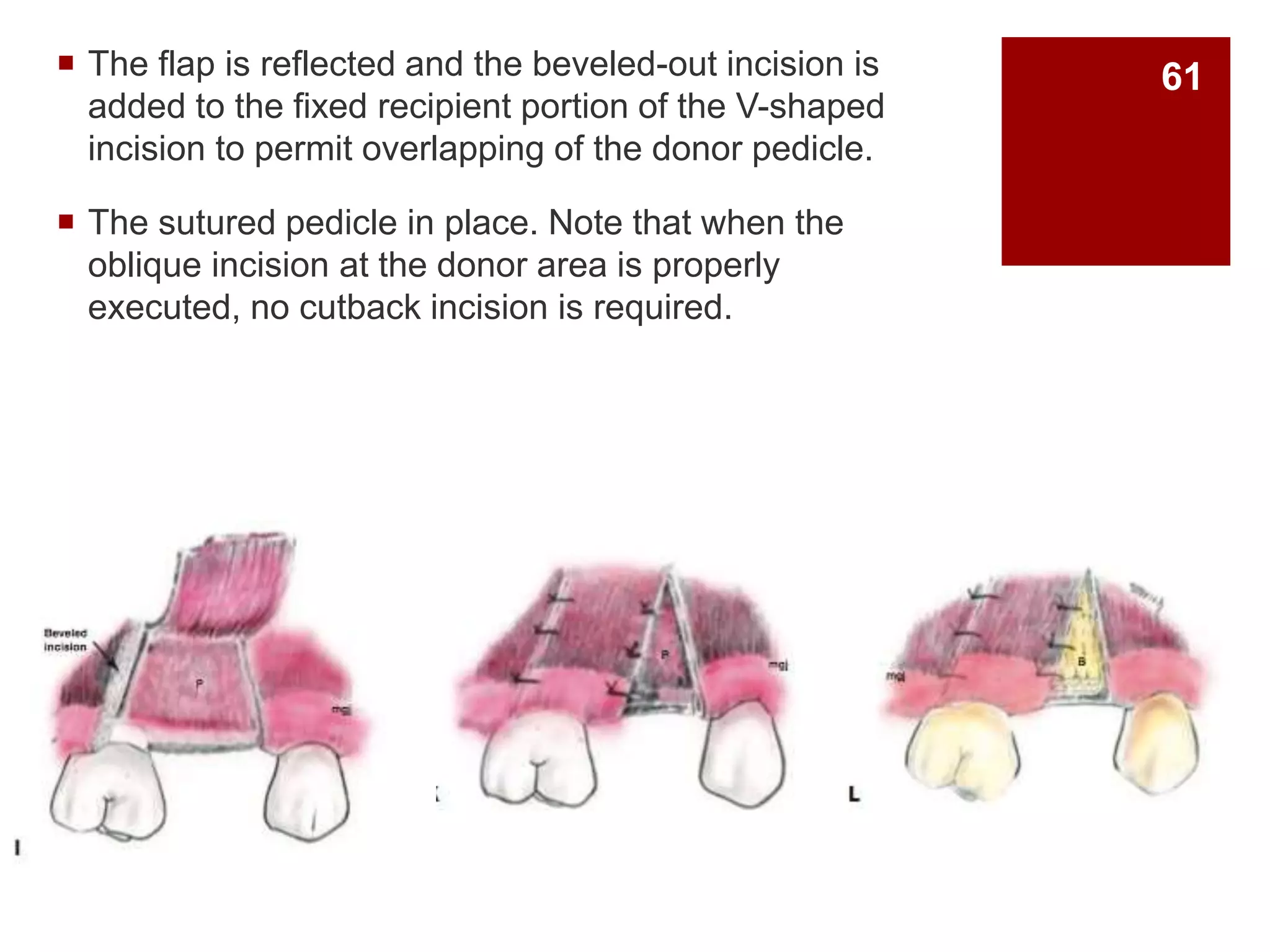 The flap is reflected and the beveled-out incision is
added to the fixed recipient portion of the V-shaped
incision to permit overlapping of the donor pedicle.
 The sutured pedicle in place. Note that when the
oblique incision at the donor area is properly
executed, no cutback incision is required.
61
 