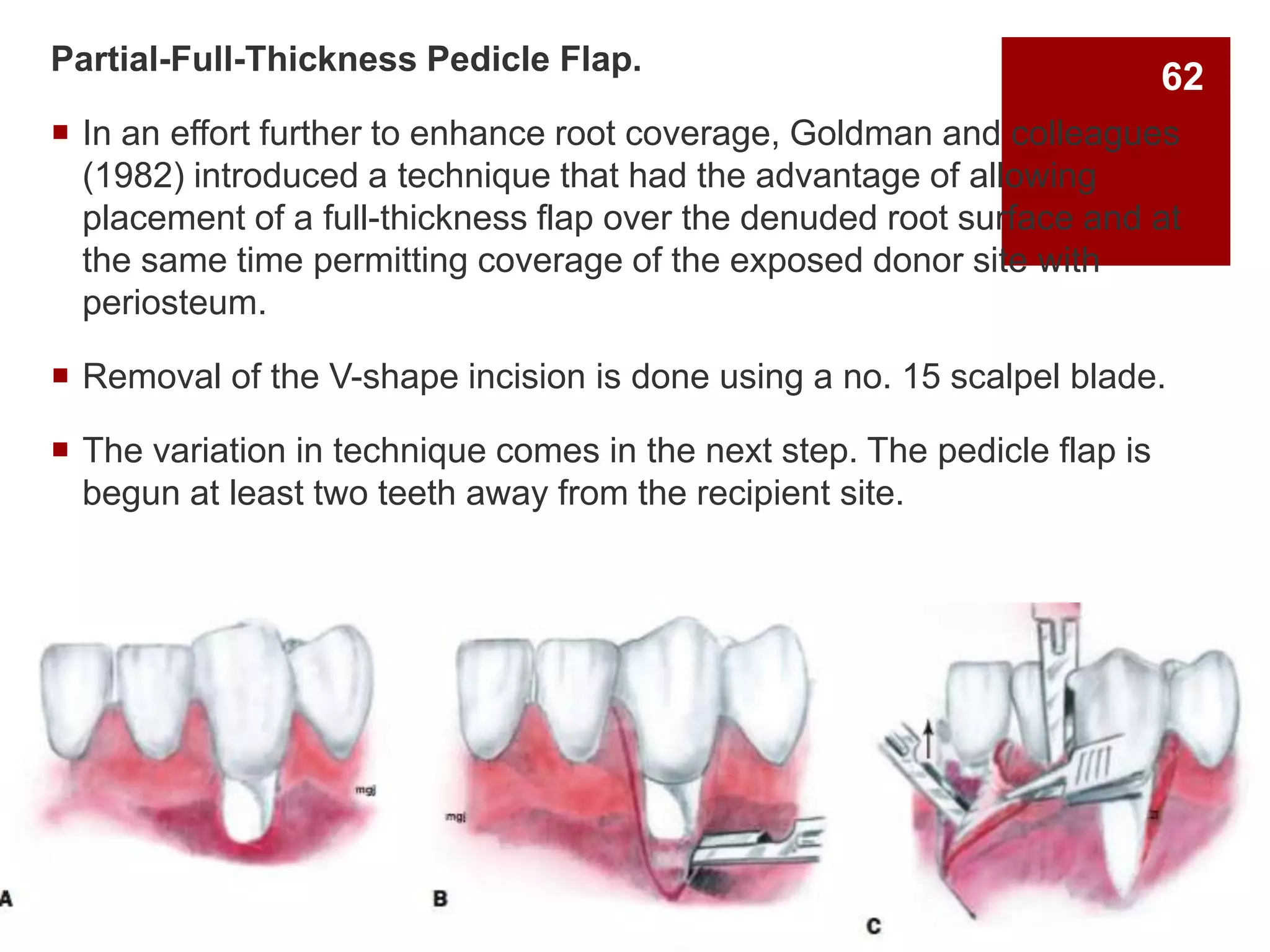 Partial-Full-Thickness Pedicle Flap.
 In an effort further to enhance root coverage, Goldman and colleagues
(1982) introduced a technique that had the advantage of allowing
placement of a full-thickness flap over the denuded root surface and at
the same time permitting coverage of the exposed donor site with
periosteum.
 Removal of the V-shape incision is done using a no. 15 scalpel blade.
 The variation in technique comes in the next step. The pedicle flap is
begun at least two teeth away from the recipient site.
62
 