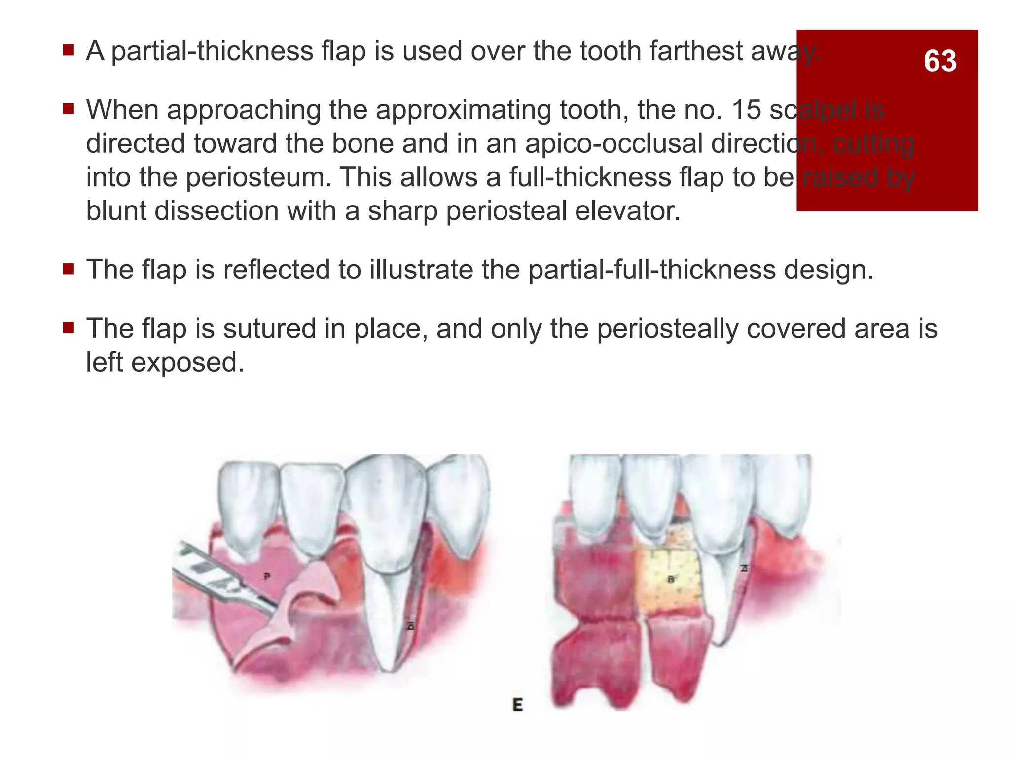 A partial-thickness flap is used over the tooth farthest away.
 When approaching the approximating tooth, the no. 15 scalpel is
directed toward the bone and in an apico-occlusal direction, cutting
into the periosteum. This allows a full-thickness flap to be raised by
blunt dissection with a sharp periosteal elevator.
 The flap is reflected to illustrate the partial-full-thickness design.
 The flap is sutured in place, and only the periosteally covered area is
left exposed.
63
 