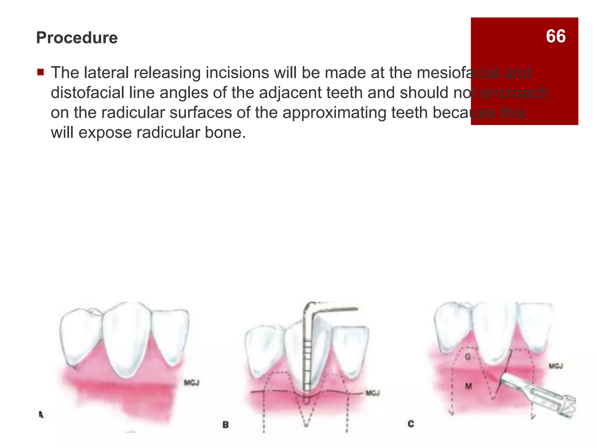 Procedure
 The lateral releasing incisions will be made at the mesiofacial and
distofacial line angles of the adjacent teeth and should not encroach
on the radicular surfaces of the approximating teeth because this
will expose radicular bone.
66
 