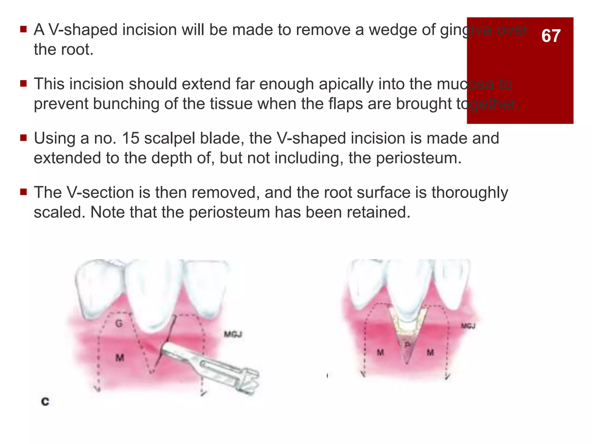  A V-shaped incision will be made to remove a wedge of gingiva over
the root.
 This incision should extend far enough apically into the mucosa to
prevent bunching of the tissue when the flaps are brought together.
 Using a no. 15 scalpel blade, the V-shaped incision is made and
extended to the depth of, but not including, the periosteum.
 The V-section is then removed, and the root surface is thoroughly
scaled. Note that the periosteum has been retained.
67
 