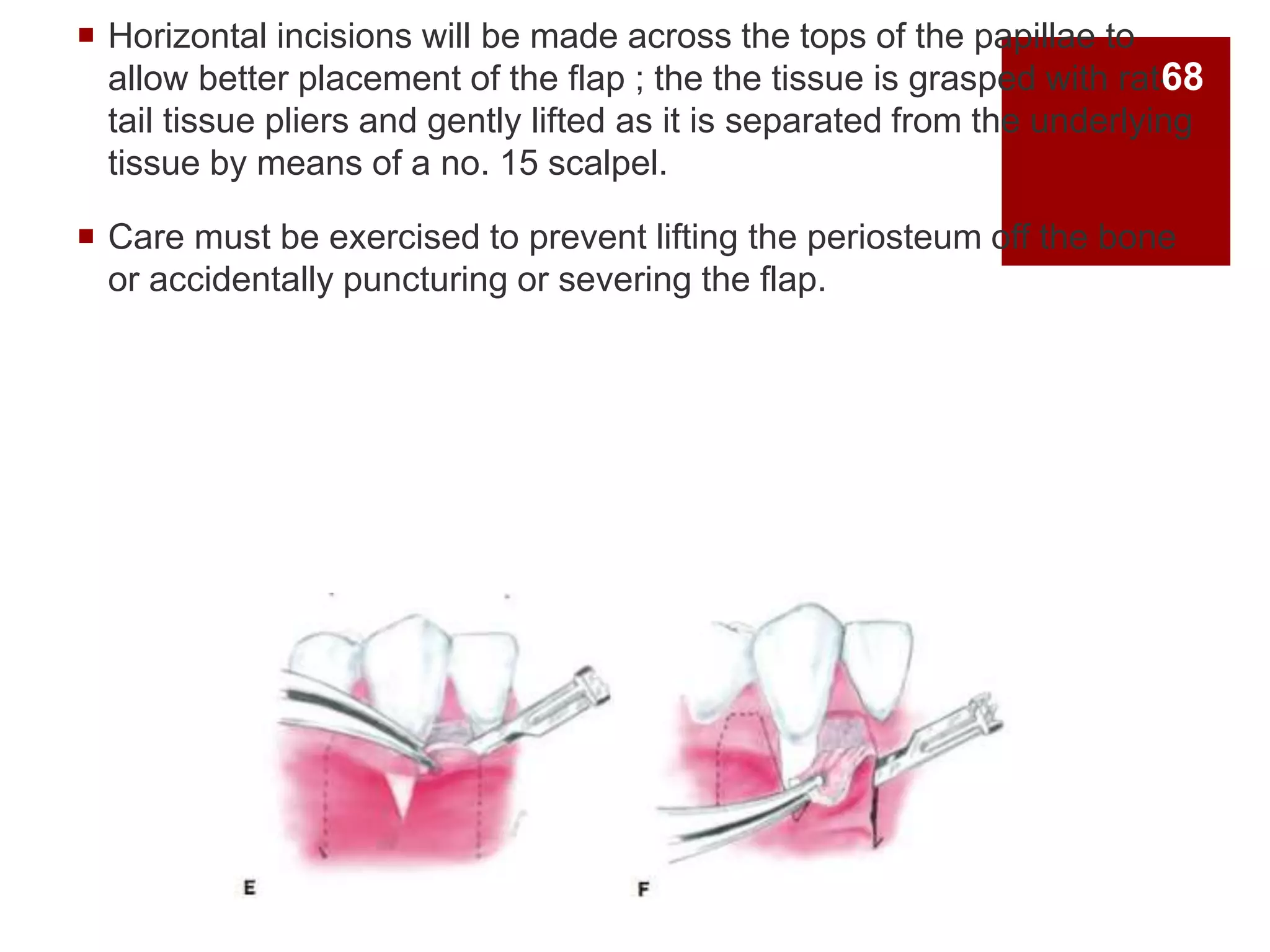  Horizontal incisions will be made across the tops of the papillae to
allow better placement of the flap ; the the tissue is grasped with rat-
tail tissue pliers and gently lifted as it is separated from the underlying
tissue by means of a no. 15 scalpel.
 Care must be exercised to prevent lifting the periosteum off the bone
or accidentally puncturing or severing the flap.
68
 
