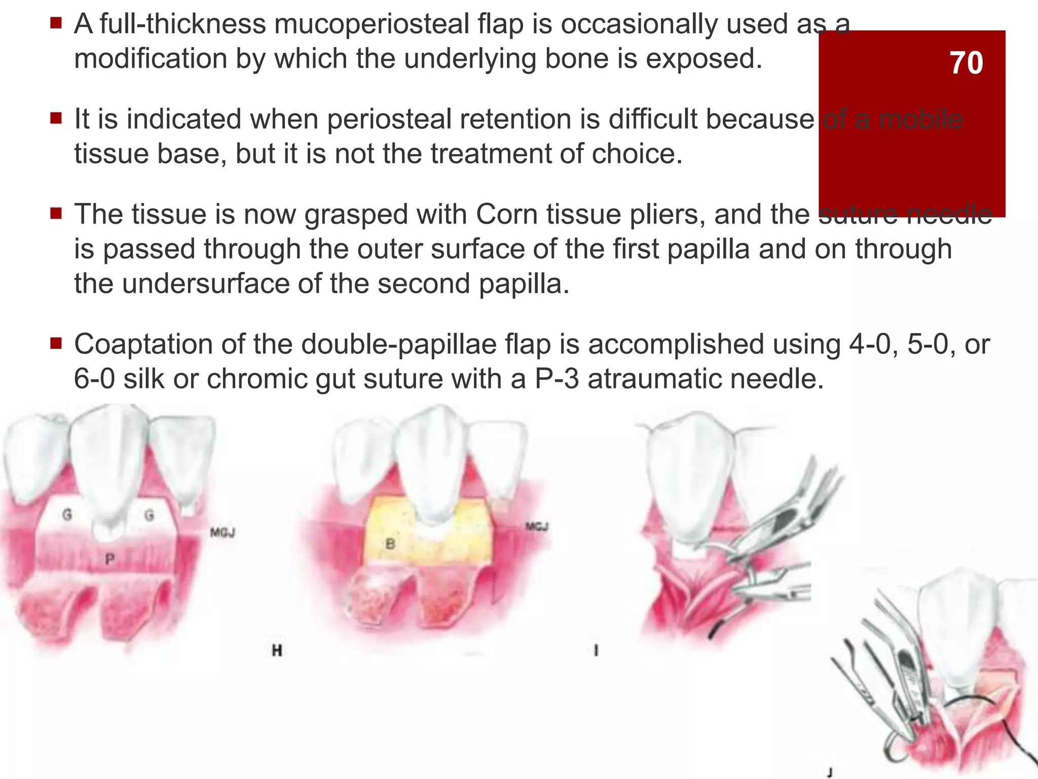  A full-thickness mucoperiosteal flap is occasionally used as a
modification by which the underlying bone is exposed.
 It is indicated when periosteal retention is difficult because of a mobile
tissue base, but it is not the treatment of choice.
 The tissue is now grasped with Corn tissue pliers, and the suture needle
is passed through the outer surface of the first papilla and on through
the undersurface of the second papilla.
 Coaptation of the double-papillae flap is accomplished using 4-0, 5-0, or
6-0 silk or chromic gut suture with a P-3 atraumatic needle.
70
 