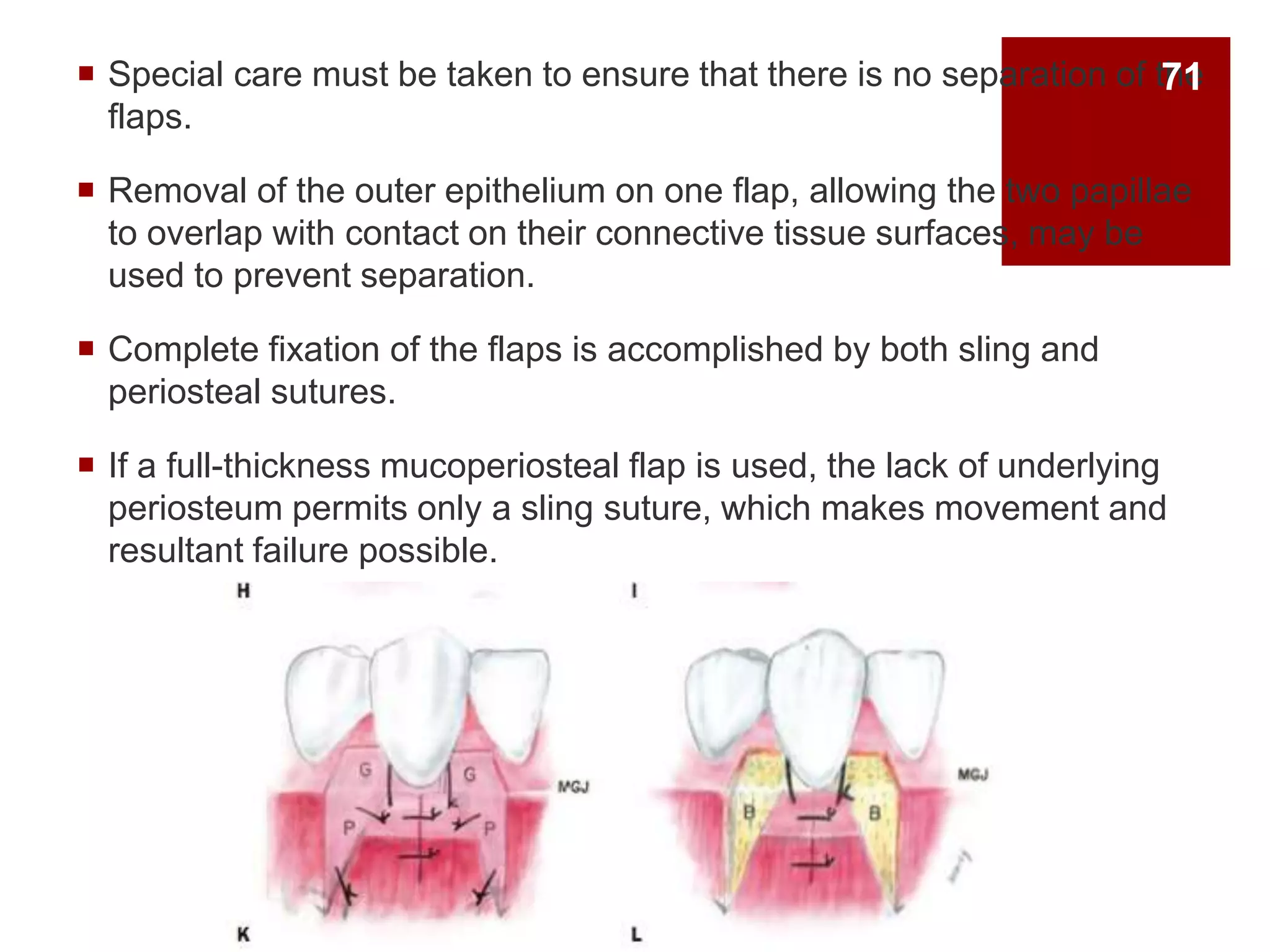  Special care must be taken to ensure that there is no separation of the
flaps.
 Removal of the outer epithelium on one flap, allowing the two papillae
to overlap with contact on their connective tissue surfaces, may be
used to prevent separation.
 Complete fixation of the flaps is accomplished by both sling and
periosteal sutures.
 If a full-thickness mucoperiosteal flap is used, the lack of underlying
periosteum permits only a sling suture, which makes movement and
resultant failure possible.
71
 