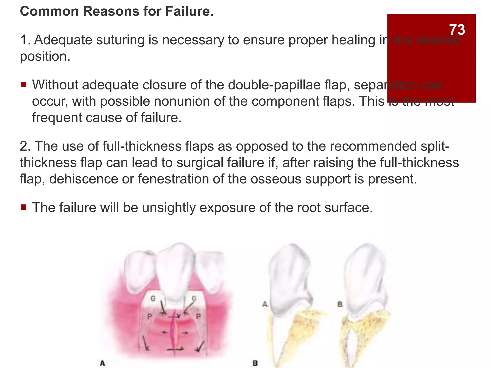 Common Reasons for Failure.
1. Adequate suturing is necessary to ensure proper healing in the desired
position.
 Without adequate closure of the double-papillae flap, separation can
occur, with possible nonunion of the component flaps. This is the most
frequent cause of failure.
2. The use of full-thickness flaps as opposed to the recommended split-
thickness flap can lead to surgical failure if, after raising the full-thickness
flap, dehiscence or fenestration of the osseous support is present.
 The failure will be unsightly exposure of the root surface.
73
 