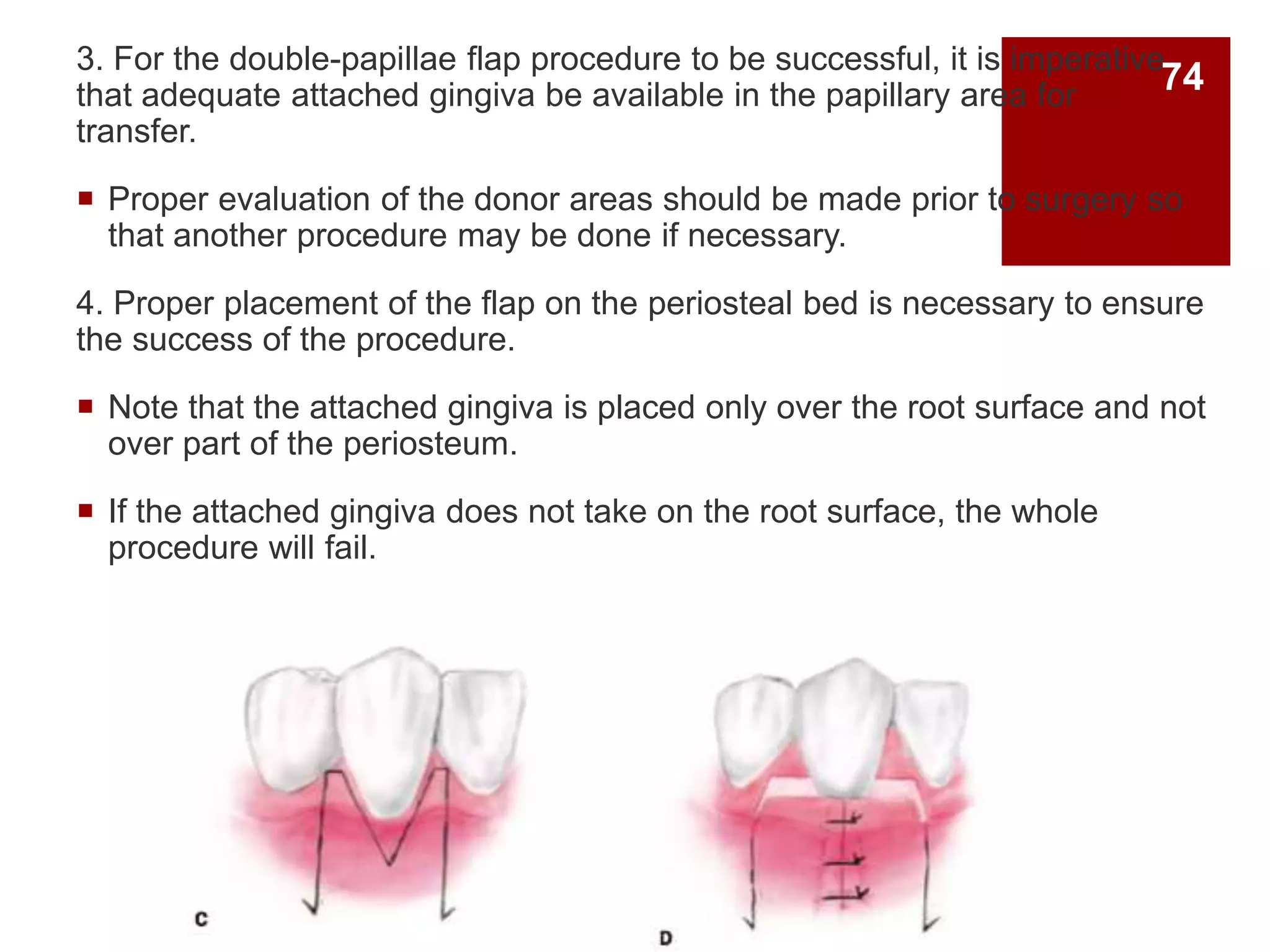 3. For the double-papillae flap procedure to be successful, it is imperative
that adequate attached gingiva be available in the papillary area for
transfer.
 Proper evaluation of the donor areas should be made prior to surgery so
that another procedure may be done if necessary.
4. Proper placement of the flap on the periosteal bed is necessary to ensure
the success of the procedure.
 Note that the attached gingiva is placed only over the root surface and not
over part of the periosteum.
 If the attached gingiva does not take on the root surface, the whole
procedure will fail.
74
 