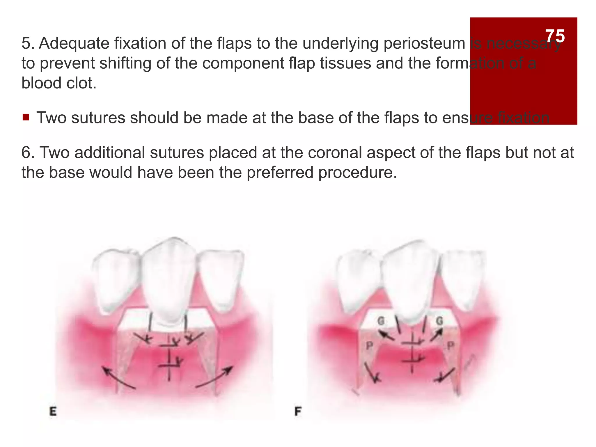 5. Adequate fixation of the flaps to the underlying periosteum is necessary
to prevent shifting of the component flap tissues and the formation of a
blood clot.
 Two sutures should be made at the base of the flaps to ensure fixation
6. Two additional sutures placed at the coronal aspect of the flaps but not at
the base would have been the preferred procedure.
75
 