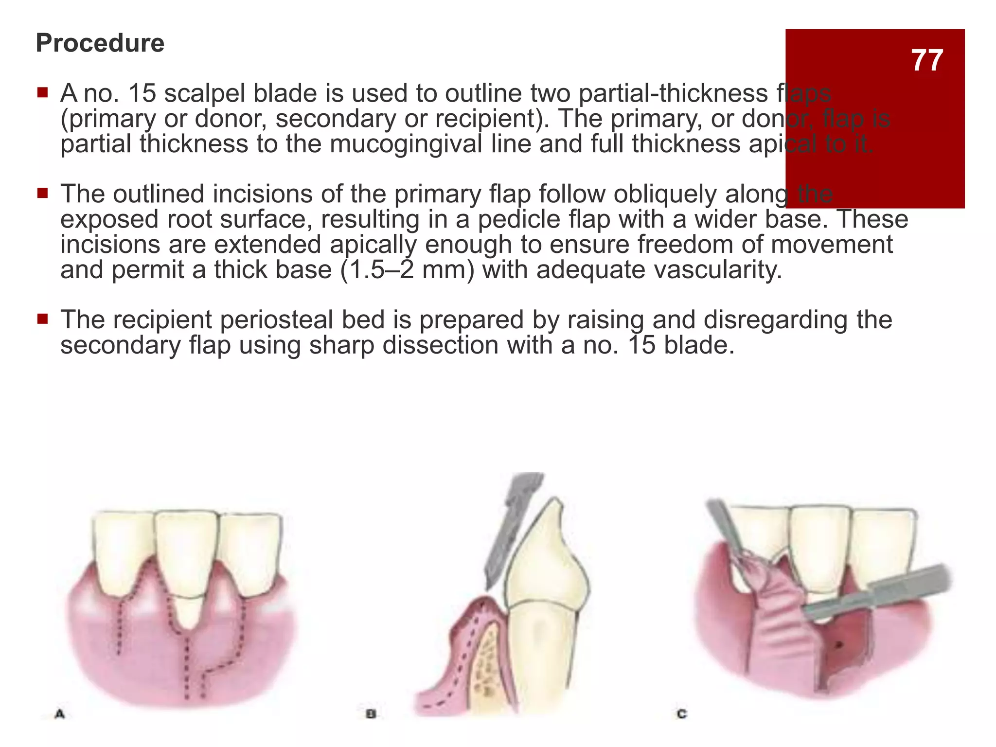 Procedure
 A no. 15 scalpel blade is used to outline two partial-thickness flaps
(primary or donor, secondary or recipient). The primary, or donor, flap is
partial thickness to the mucogingival line and full thickness apical to it.
 The outlined incisions of the primary flap follow obliquely along the
exposed root surface, resulting in a pedicle flap with a wider base. These
incisions are extended apically enough to ensure freedom of movement
and permit a thick base (1.5–2 mm) with adequate vascularity.
 The recipient periosteal bed is prepared by raising and disregarding the
secondary flap using sharp dissection with a no. 15 blade.
77
 
