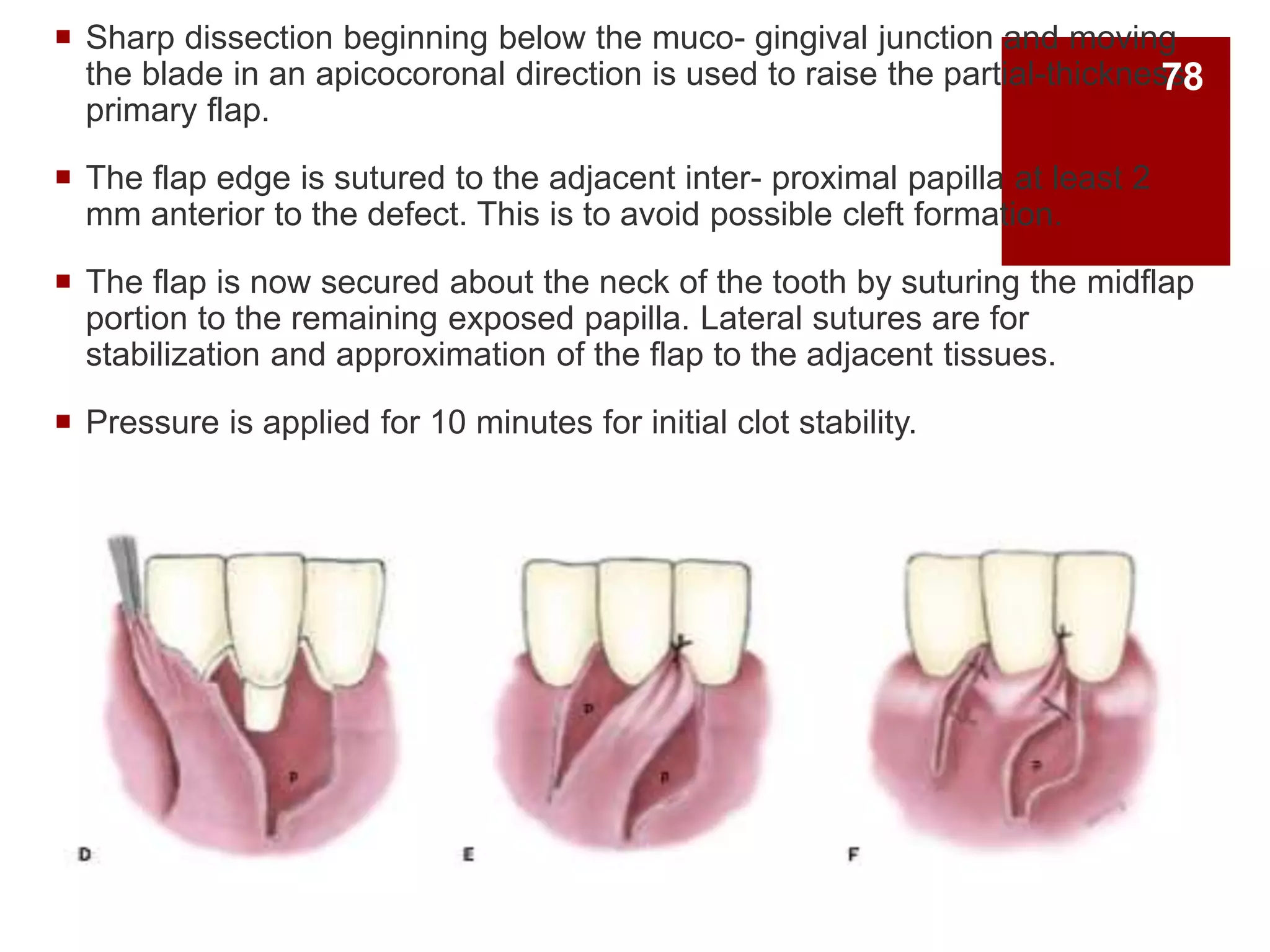  Sharp dissection beginning below the muco- gingival junction and moving
the blade in an apicocoronal direction is used to raise the partial-thickness
primary flap.
 The flap edge is sutured to the adjacent inter- proximal papilla at least 2
mm anterior to the defect. This is to avoid possible cleft formation.
 The flap is now secured about the neck of the tooth by suturing the midflap
portion to the remaining exposed papilla. Lateral sutures are for
stabilization and approximation of the flap to the adjacent tissues.
 Pressure is applied for 10 minutes for initial clot stability.
78
 
