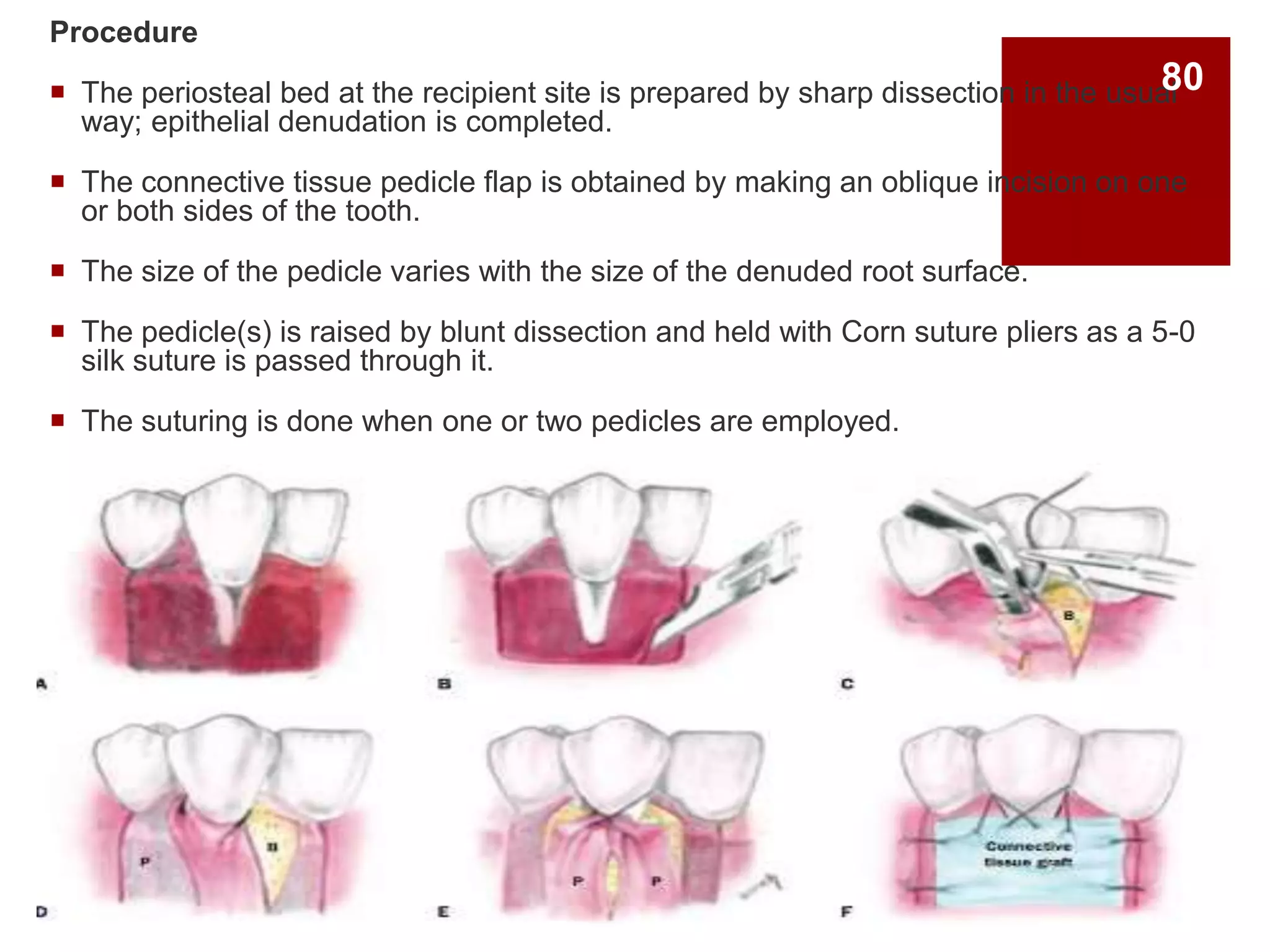 Procedure
 The periosteal bed at the recipient site is prepared by sharp dissection in the usual
way; epithelial denudation is completed.
 The connective tissue pedicle flap is obtained by making an oblique incision on one
or both sides of the tooth.
 The size of the pedicle varies with the size of the denuded root surface.
 The pedicle(s) is raised by blunt dissection and held with Corn suture pliers as a 5-0
silk suture is passed through it.
 The suturing is done when one or two pedicles are employed.
80
 