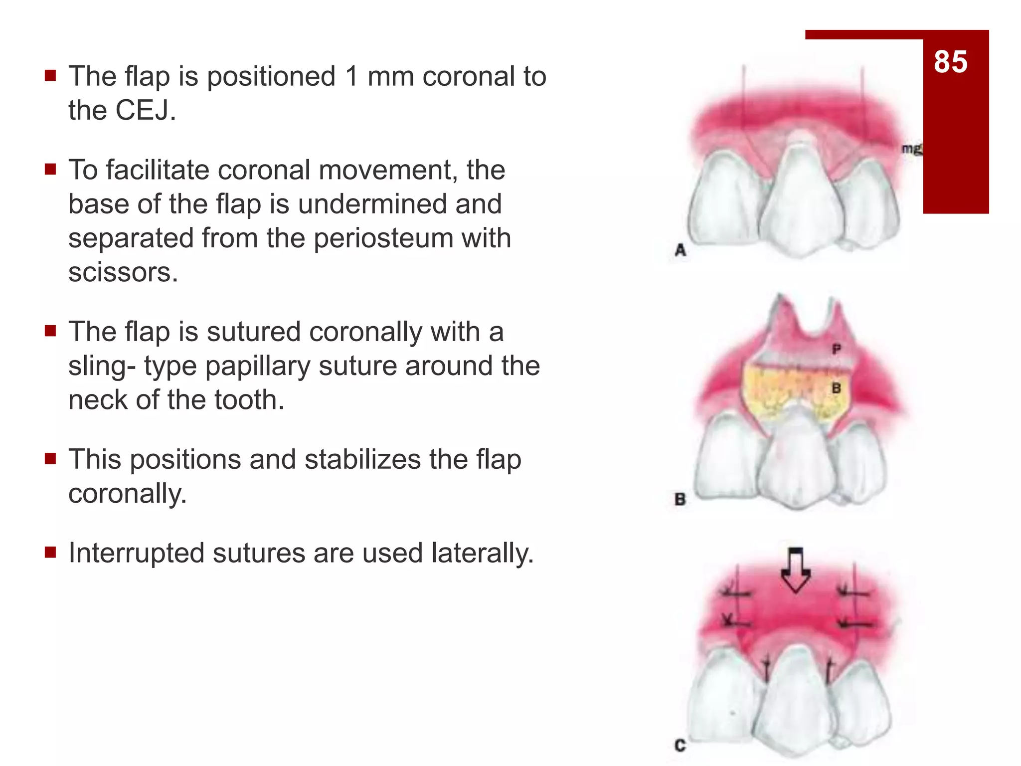  The flap is positioned 1 mm coronal to
the CEJ.
 To facilitate coronal movement, the
base of the flap is undermined and
separated from the periosteum with
scissors.
 The flap is sutured coronally with a
sling- type papillary suture around the
neck of the tooth.
 This positions and stabilizes the flap
coronally.
 Interrupted sutures are used laterally.
85
 