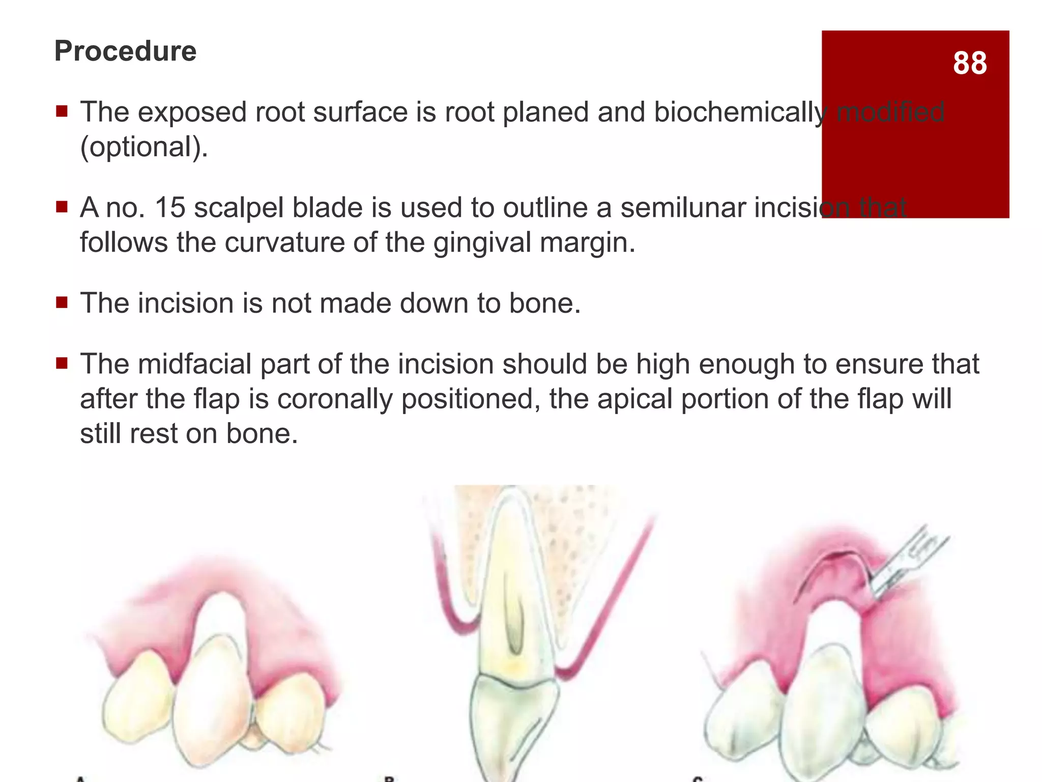 Procedure
 The exposed root surface is root planed and biochemically modified
(optional).
 A no. 15 scalpel blade is used to outline a semilunar incision that
follows the curvature of the gingival margin.
 The incision is not made down to bone.
 The midfacial part of the incision should be high enough to ensure that
after the flap is coronally positioned, the apical portion of the flap will
still rest on bone.
88
 