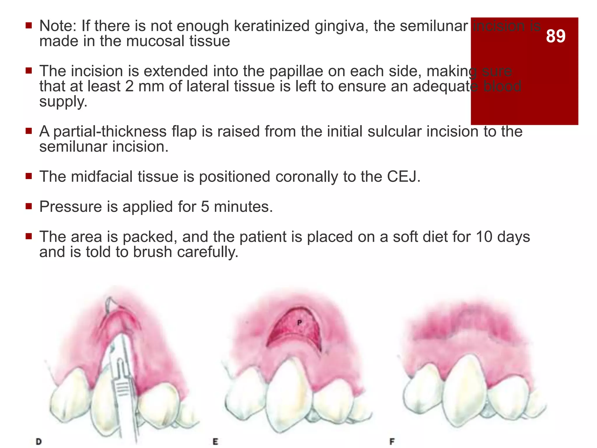  Note: If there is not enough keratinized gingiva, the semilunar incision is
made in the mucosal tissue
 The incision is extended into the papillae on each side, making sure
that at least 2 mm of lateral tissue is left to ensure an adequate blood
supply.
 A partial-thickness flap is raised from the initial sulcular incision to the
semilunar incision.
 The midfacial tissue is positioned coronally to the CEJ.
 Pressure is applied for 5 minutes.
 The area is packed, and the patient is placed on a soft diet for 10 days
and is told to brush carefully.
89
 