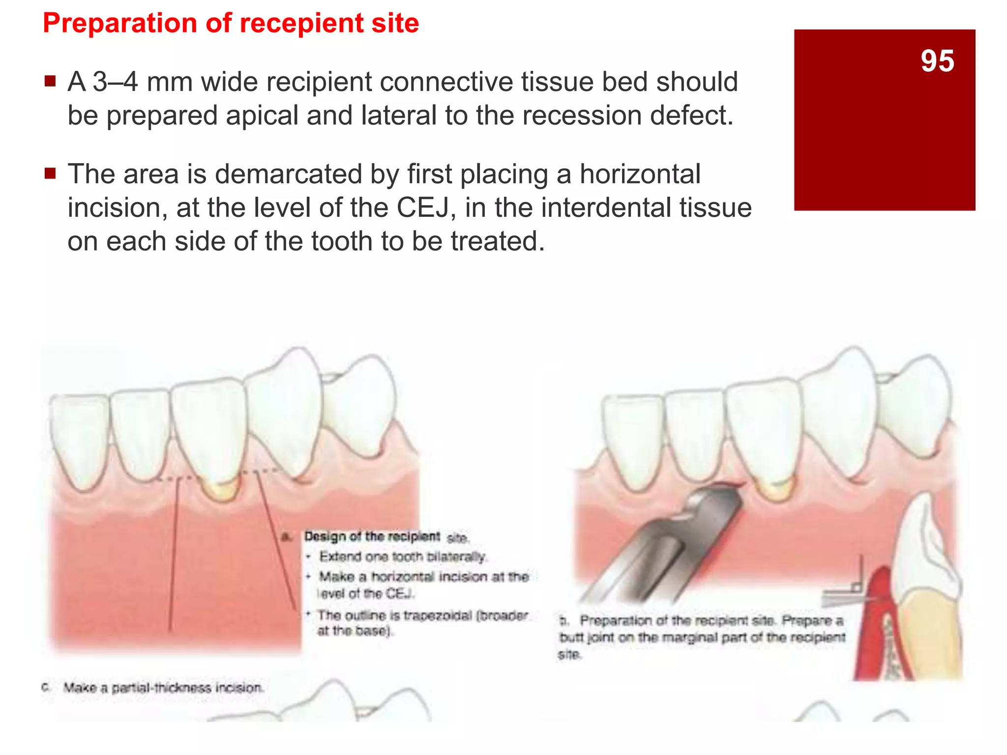 Preparation of recepient site
 A 3–4 mm wide recipient connective tissue bed should
be prepared apical and lateral to the recession defect.
 The area is demarcated by first placing a horizontal
incision, at the level of the CEJ, in the interdental tissue
on each side of the tooth to be treated.
95
 