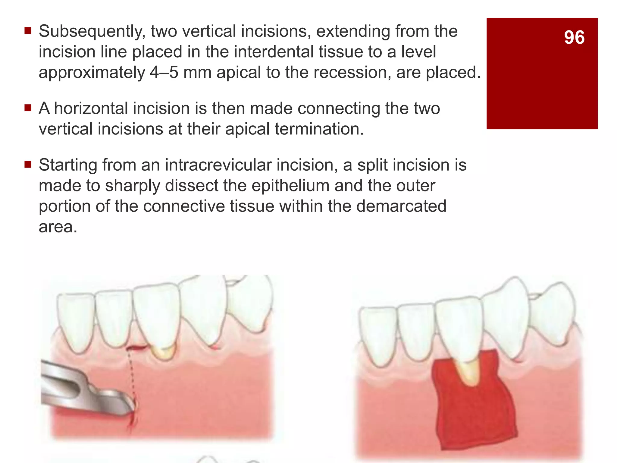  Subsequently, two vertical incisions, extending from the
incision line placed in the interdental tissue to a level
approximately 4–5 mm apical to the recession, are placed.
 A horizontal incision is then made connecting the two
vertical incisions at their apical termination.
 Starting from an intracrevicular incision, a split incision is
made to sharply dissect the epithelium and the outer
portion of the connective tissue within the demarcated
area.
96
 