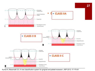 Root coverage procedures. Dr. Kinjal ghelani | PPTX