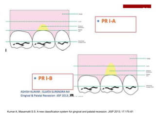 Root coverage procedures. Dr. Kinjal ghelani | PPTX
