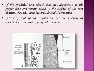 • If the epithelial root sheath does not degenerate at the
proper time and remain stuck to the surface of the root
dentine, then that area becomes devoid of cementum
• Areas of root without cementum can be a cause of
sensitivity if the there is gingival recession
 