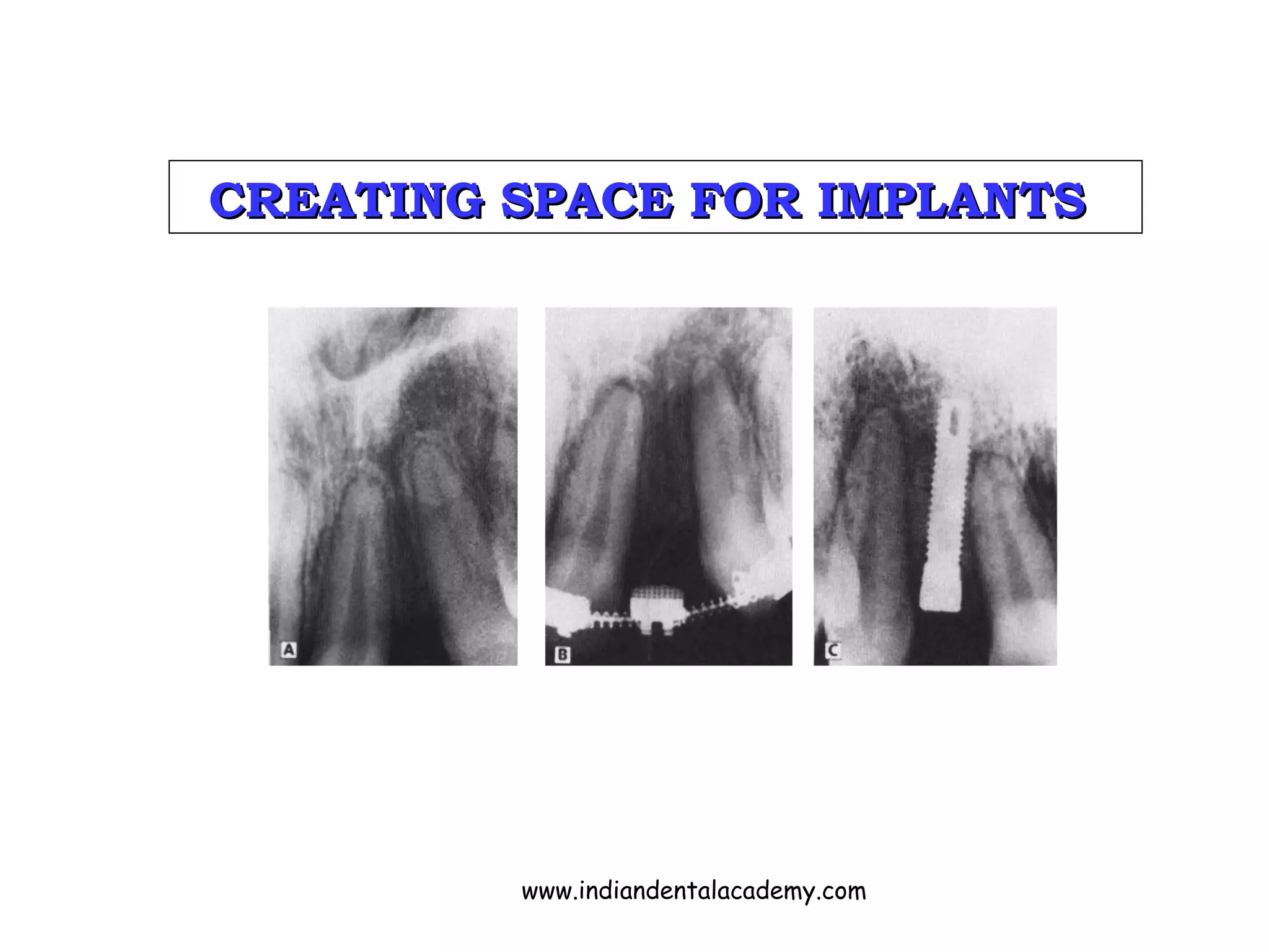 CREATING SPACE FOR IMPLANTSCREATING SPACE FOR IMPLANTS
www.indiandentalacademy.com
 