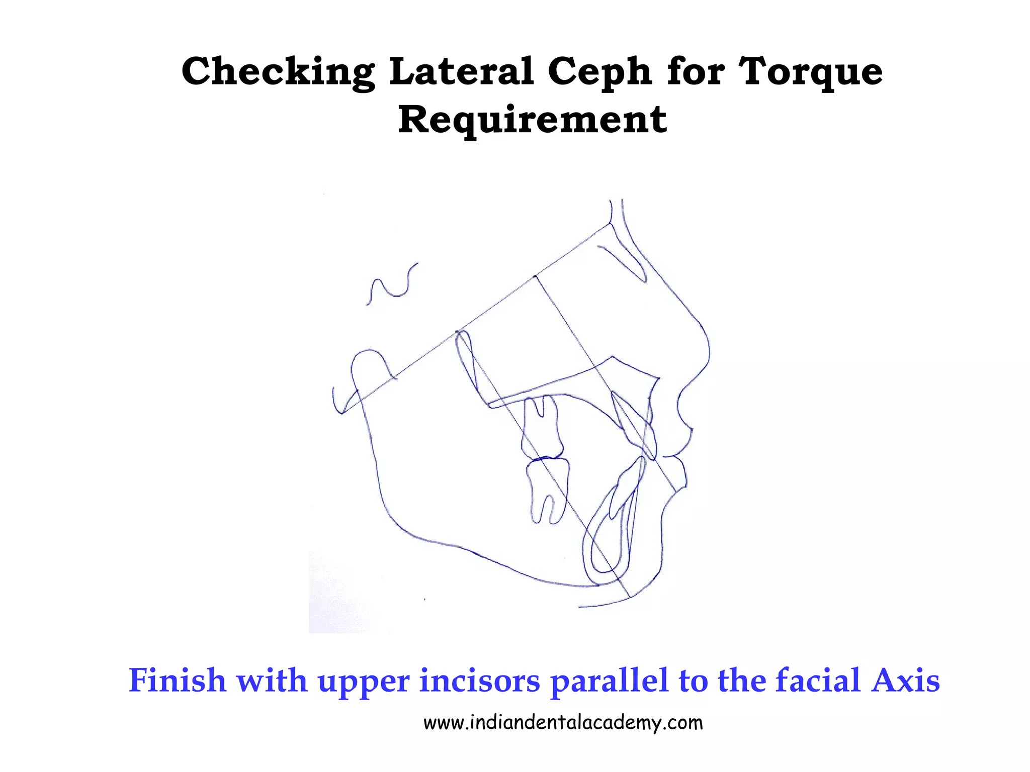 Checking Lateral Ceph for Torque
Requirement
Finish with upper incisors parallel to the facial Axis
www.indiandentalacademy.com
 