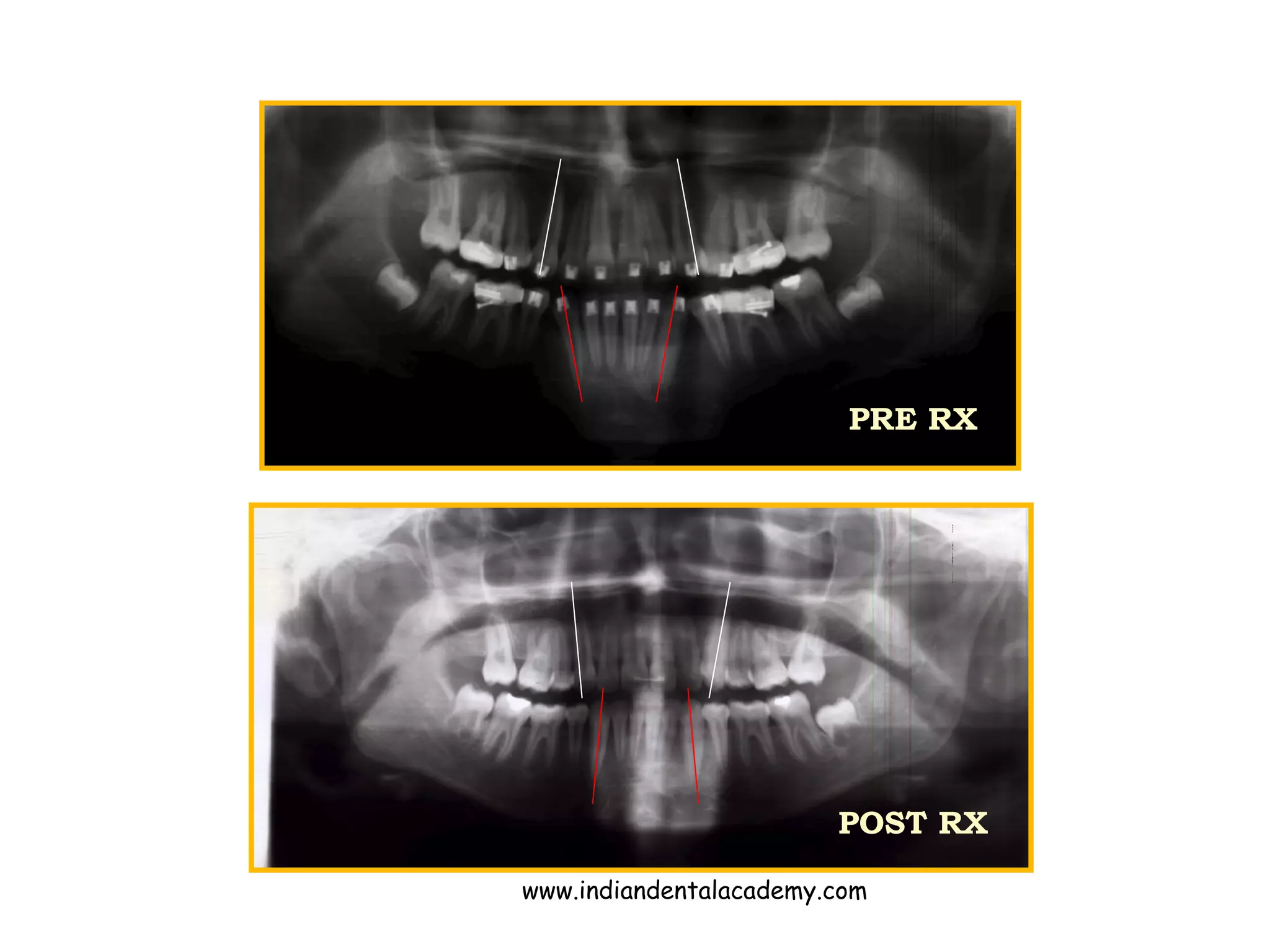 PRE RX
POST RX
www.indiandentalacademy.com
 
