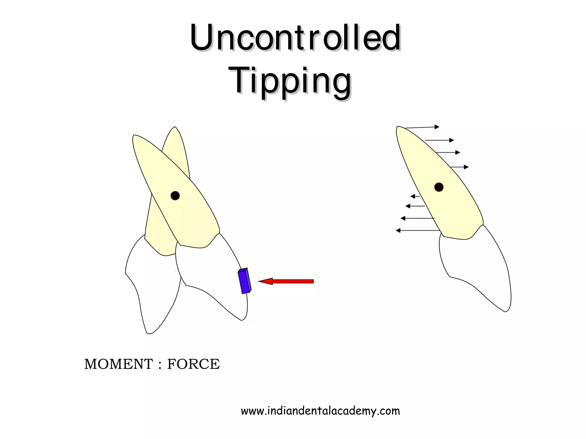 UncontrolledUncontrolled
TippingTipping
MOMENT : FORCE
www.indiandentalacademy.com
 
