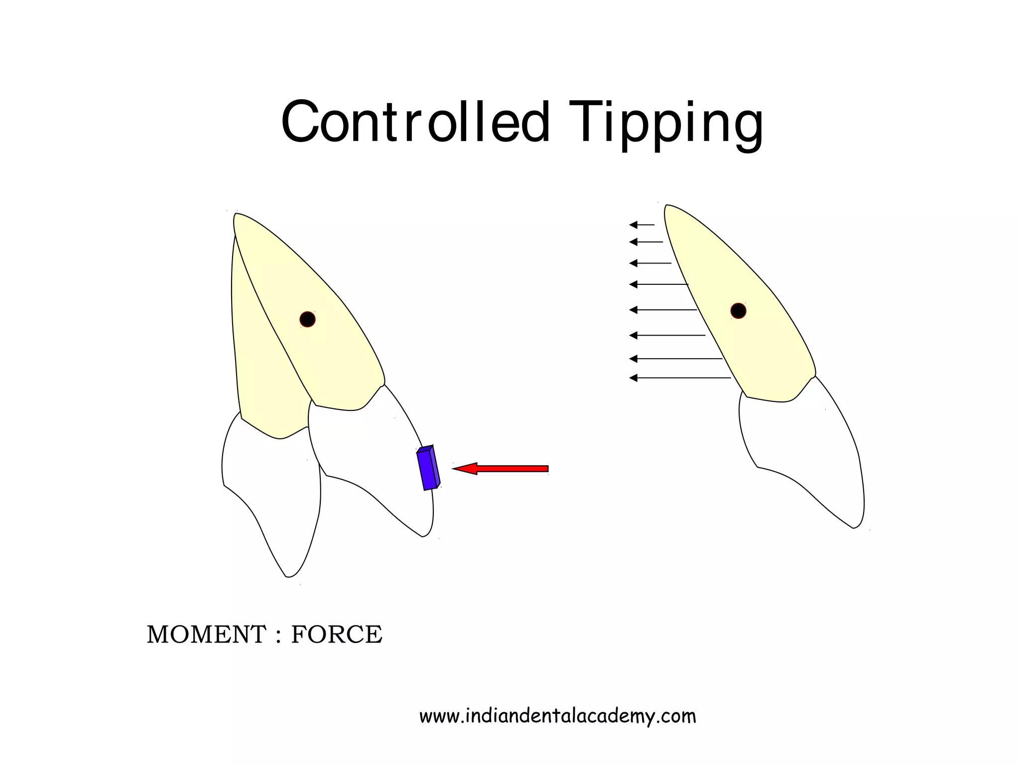 Controlled Tipping
MOMENT : FORCE
www.indiandentalacademy.com
 