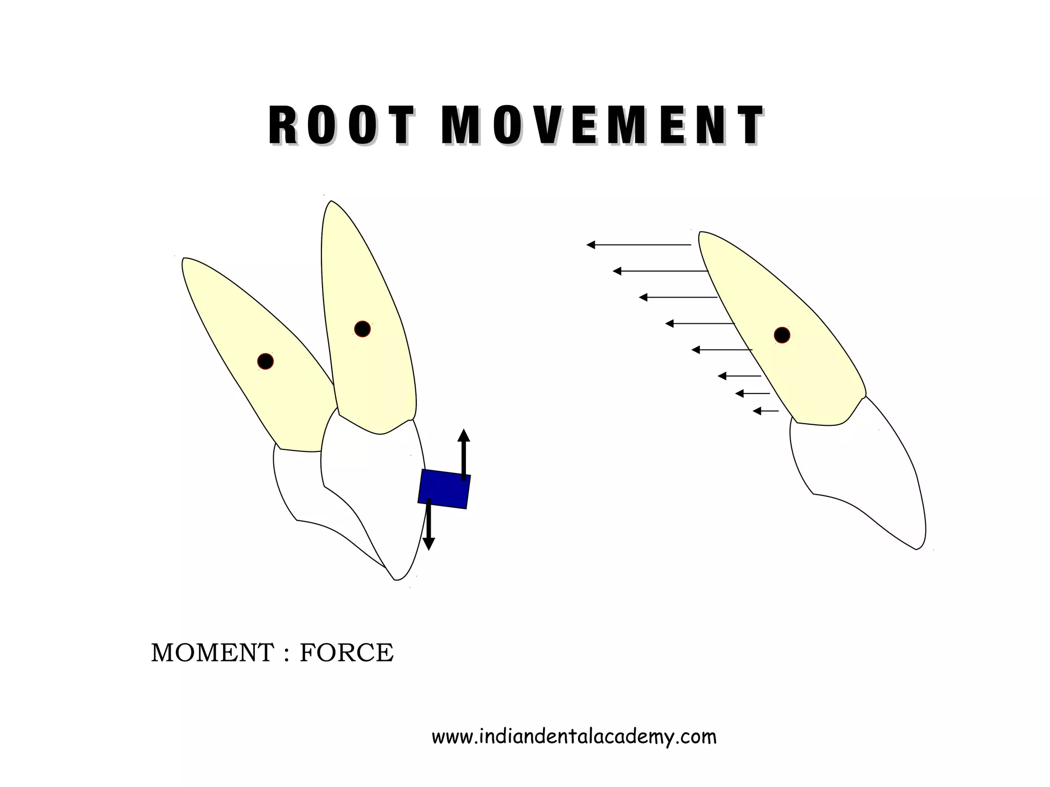 R O O T M O V E M E N TR O O T M O V E M E N T
MOMENT : FORCE
www.indiandentalacademy.com
 