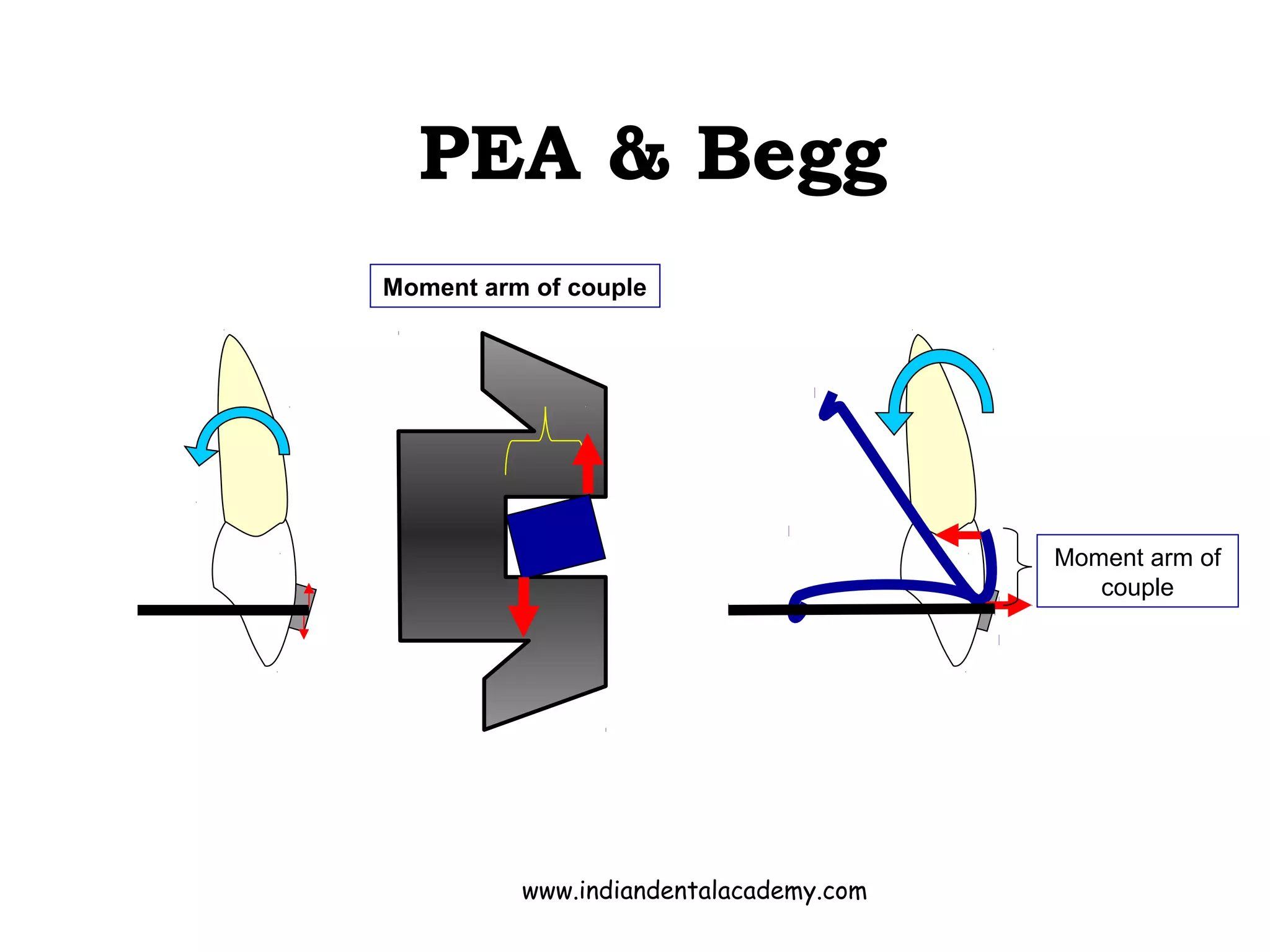 PEA & Begg
Moment arm of
couple
Moment arm of couple
www.indiandentalacademy.com
 