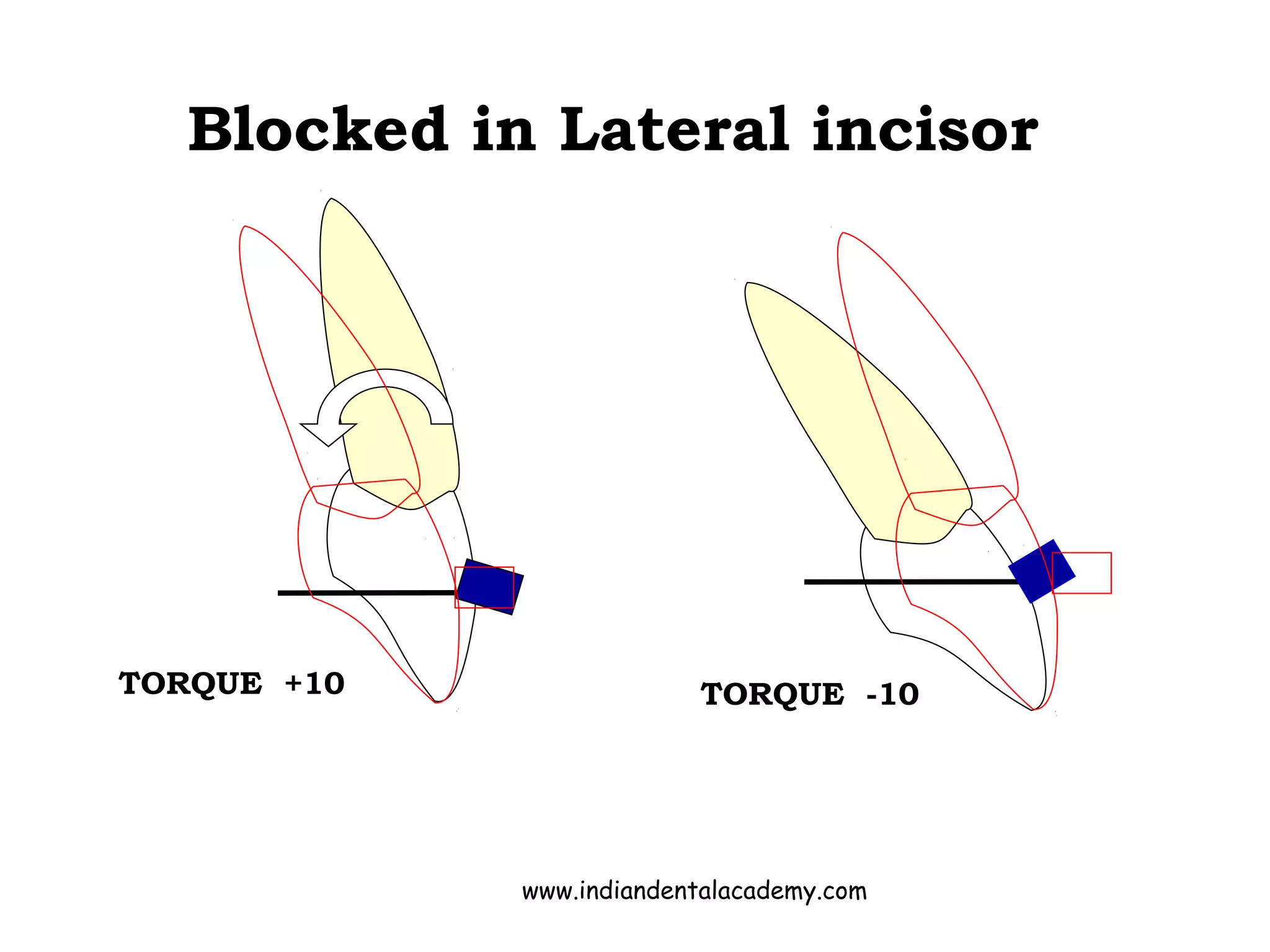 TORQUE +10 TORQUE -10
Blocked in Lateral incisor
www.indiandentalacademy.com
 