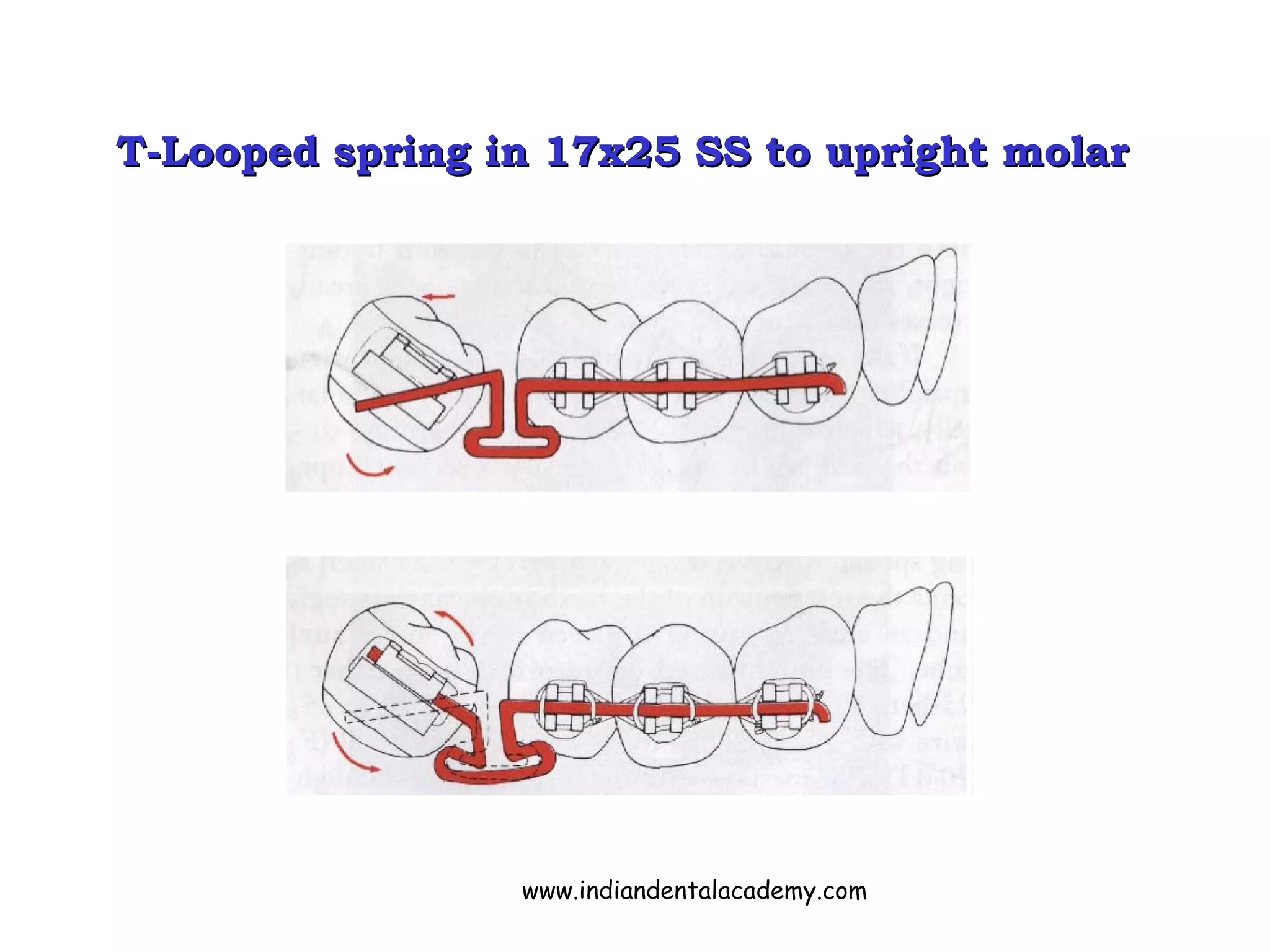T-Looped spring in 17x25 SS to upright molarT-Looped spring in 17x25 SS to upright molar
www.indiandentalacademy.com
 